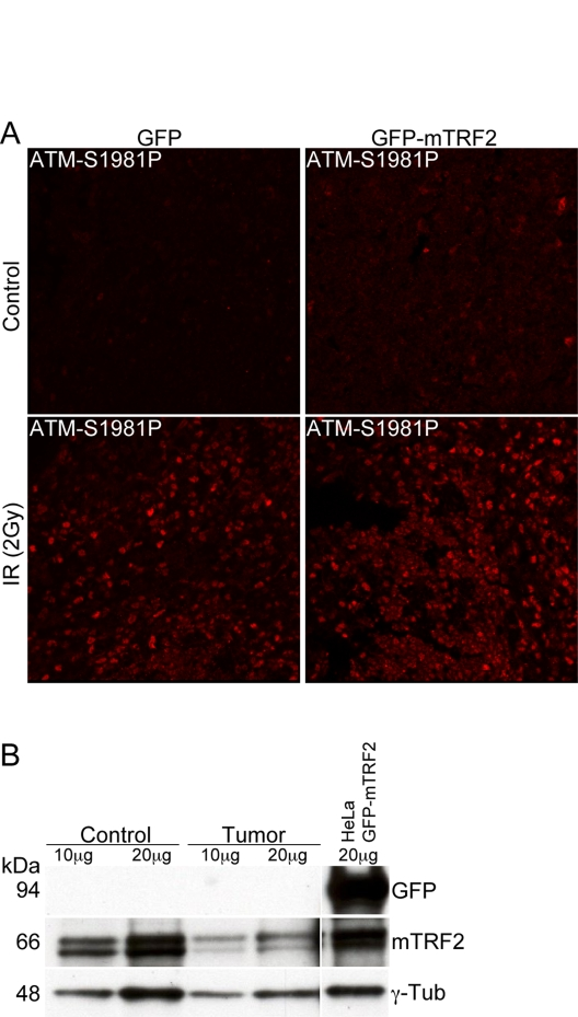 The ATM dependent damage response is not compromised in tumor samples