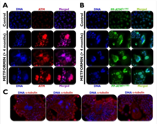 Chronic exposure to metformin activates the DNA damage sensor kinase ATM in poly-morphic, polyploidy [A431] cancer cells that contained giant nuclei and/or multiple varied size nuclei, including micronuclei (A, B). Chronically-treated cells demonstrated a large, spreading and flattening morphology, typical of senescent cells (C).