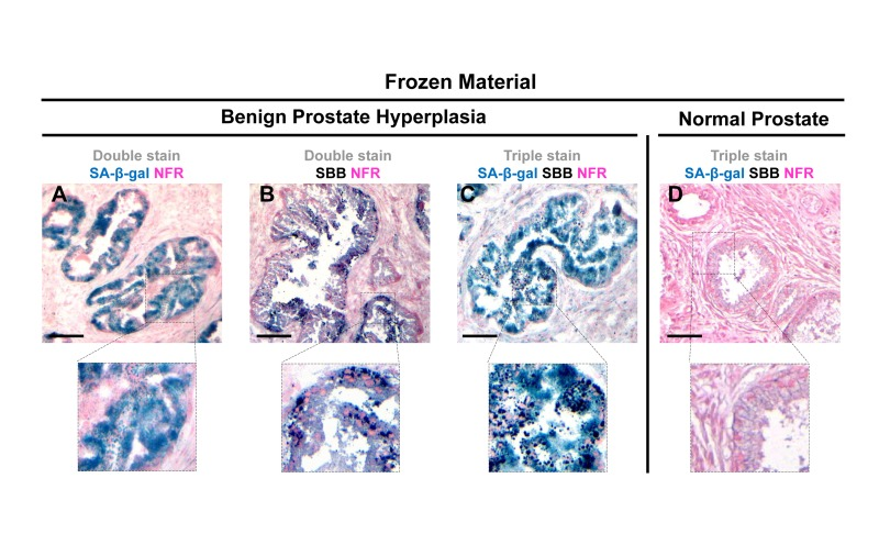 Lipofuscin accumulates and co-localizes with Senescence-Associated beta-galactosidase (SA-β-gal) in senescent cells detected in cryo-preserved material from benign prostatic hyperplasia (BPH)