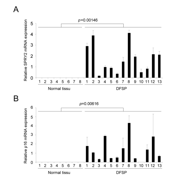 DFSP displays accumulation of senescence markers