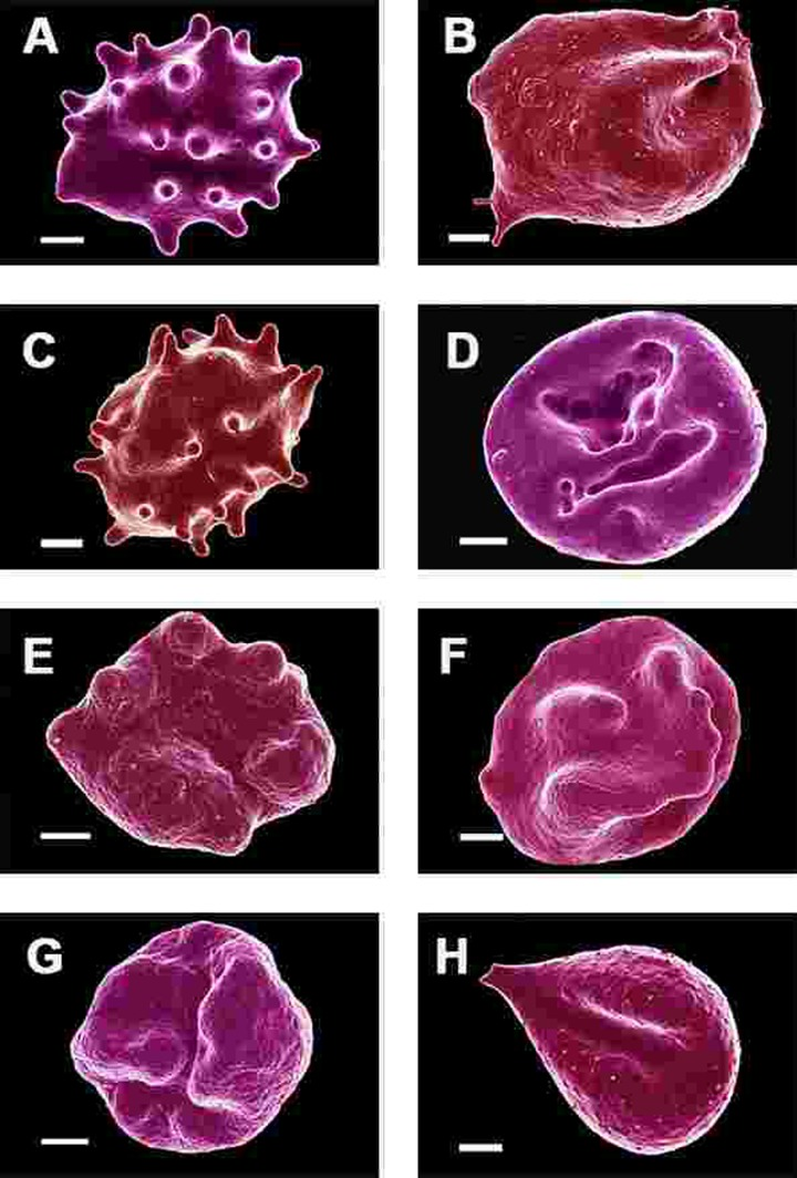 Erythrocytes of Parkinson's disease patients prepared from whole blood smears. Serum ferritin levels: (A) 80 ng.mL‐1 (B) 194 ng.mL‐1 (C) 90 ng.mL‐1 (D) 90 ng.mL−1 (E) 145 ng.mL‐1 (F) 358 ng.mL‐1 (G) 145 ng.mL‐1 (H) 21 ng.mL−1 Scale bar = 1μm.