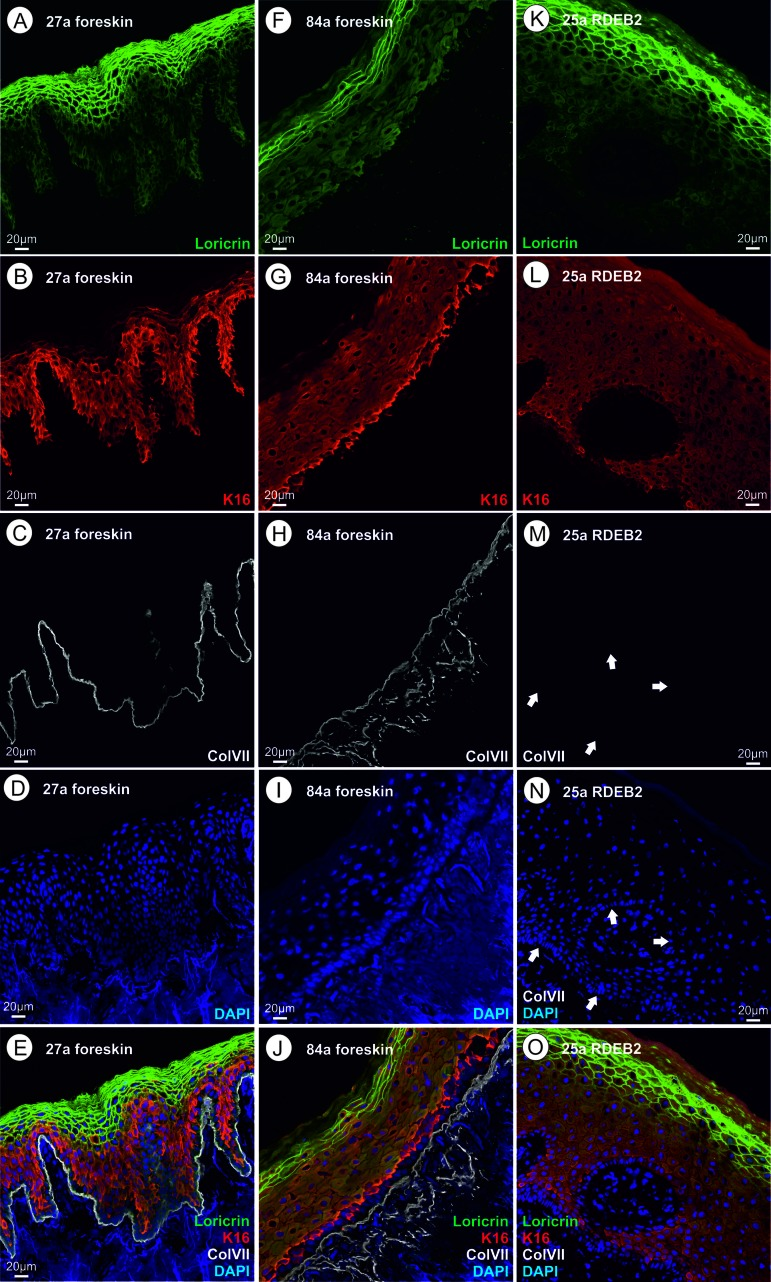 (A‐E) skin thin section of a healthy 27 year old proband; A loricrin immune fluorescence; B keratin XVI immune fluoresecence; C collagen VII immune fluorescence using a mouse monoclonal antibody directed to a C-terminal epitope of collagen VII; d DAPI; E overlay of A – D. (F–J) skin thin section of a healthy 84 year old proband; immunofluorescent stains as in A through D; J overlay of F – I. (K–O) skin thin section of a 25 year old RDEB patient; ; immunofluorescent stains as in A through D, arrows point to the basal lamina where the collagen VII stain would be expected; O overlay of K – N. Please see text for an interpretation of this figure.