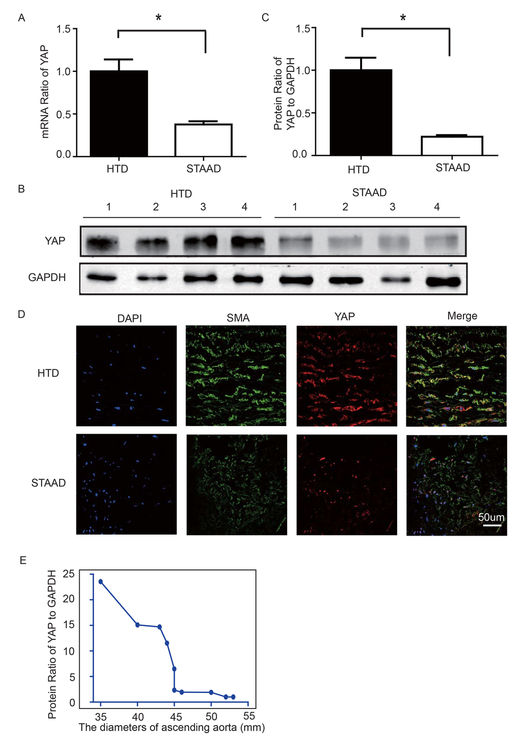 (A) Real-time PCR results showing that YAP was significantly down-regulated in the ascending aortic wall of patients with STAAD compared to HTDs (n=19 in HTD group, n=23 in STAAD group, *p=0.0003). (B, C) Western blotting showed that the expression of total YAP proteins was significantly lower in the ascending aortic wall of patients with STAAD compared to HTDs (n=19 in HTD group, n=23 in STAAD group, *p=0.0019). (D) Confocal fluorescence microscopy showing that YAP and α-SMA double stained cells were present at lower numbers and less quantity in patients with STAAD compared to HTDs. (E) Quantified and statistical analyzed of each patient sample’s Western blotting result showed that YAP expression was negatively correlated with the ascending aorta diameter (n=10).