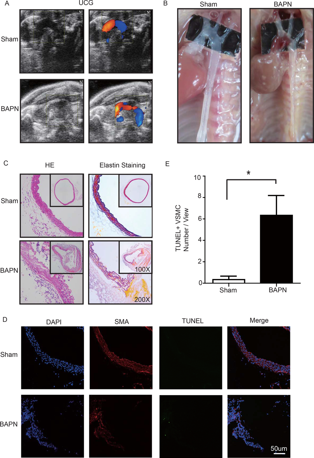 (A) Echocardiographic results showing that the area of the ascending aorta without colorful blood flow in the BAPN model suggesting a false cavity of dissection. (B) Gross examination revealing mural hematomas in the BAPN model, suggesting a false cavity of dissection. (C) H&E and elastin staining showing obvious disorganization of the aortic tissue structure in the BAPN model. (D, E) Confocal fluorescence microscopy showing that the cell number of double stained (TUNEL and α-SMA) cells was significantly more in the BAPN-induced ascending aortic dissection model (n=10 in Sham group, n=10 in BAPN group, *p=0.0335).