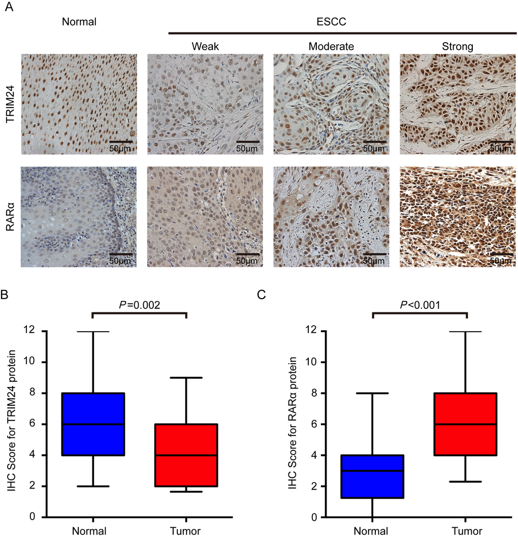 TRIM24 and RARα protein expression in ESCCs and adjacent NCETs. (A) Representative immunohistochemistry images for TRIM24 (upper panel) and RARα (lower panel) protein expression were presented. Upper panel: The first image represents the high expression of TRIM24 in an adjacent NCET, and then weak, moderate and strong expressions of TRIM24 protein in ESCC tissues. Lower panel: The first image represents the very weak expression of RARα in adjacent non-cancerous tissues, and then weak, moderate and strong expressions of RARα in ESCC tissues. All the images were shot at 200x magnification. (B) and (C) TRIM24 and RARα protein expression levels were compared between ESCC and adjacent NCET specimens. Statistical analyses were performed by Paired-Samples t-test.