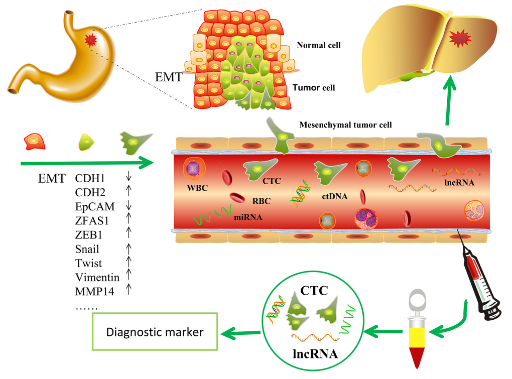 The potential role of lncRNA ZFAS1 in GC. ZFAS1contributed to the regulation of EMT in GC progression and thus may serve as a potential diagnostic marker for GC.