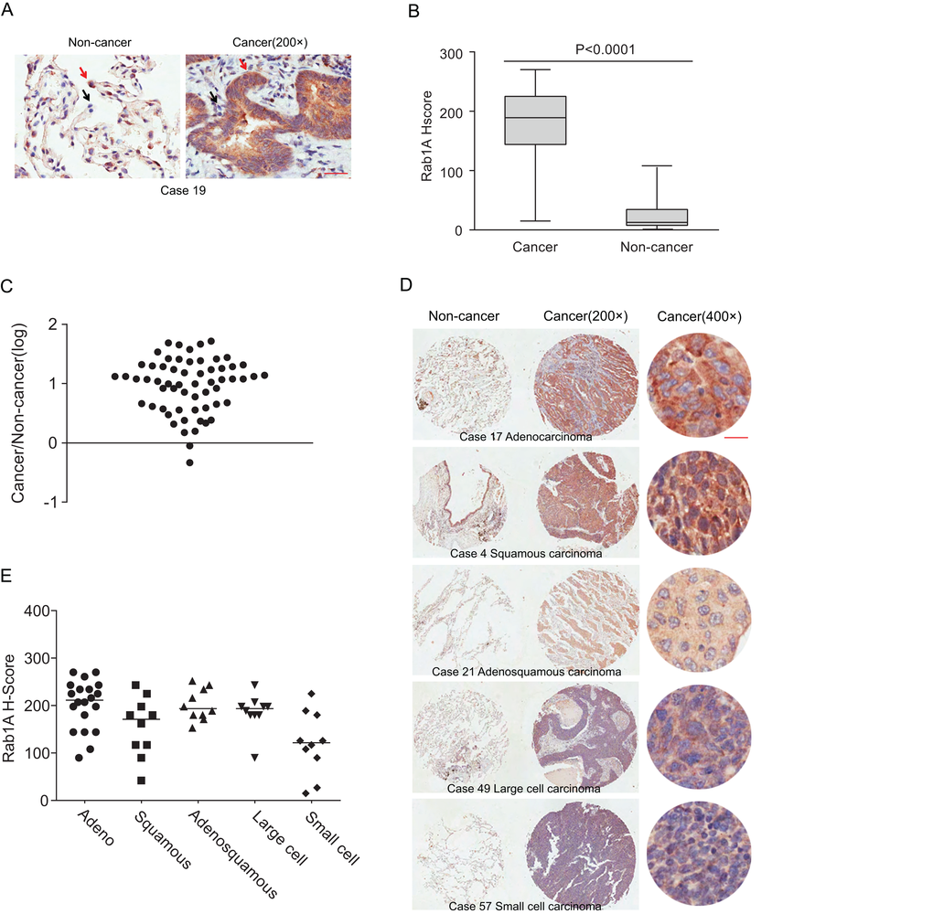 Rab1A is frequently overexpressed in different histological types of lung cancer. (A) IHC staining of human lung cancer tissue and noncancerous tissues. Shown are representative images of stained tumor and non-cancerous tissue sections. Red arrowhead: high Rab1A staining; black arrowhead: low Rab1A staining. Scale bar = 50 µm. (B) Box plot graph showing the statistical analysis of Rab1A expression in lung cancer and paired non-cancerous tissues. (C) Scatter plot showing Rab1A staining levels in individual tumors as a ratio of Rab1A staining in lung cancer to the paired non-cancerous tissue. (D) IHC staining of human lung cancer tissue microarray and paired noncancerous tissues. Shown are stained tumor and non-cancerous tissue sections representative of different histological types. Scale bar = 20 µm. (E) Scatter plot showing levels of Rab1A staining in different histological types of lung cancer as a ratio of Rab1A staining in cancer tissues to paired non-cancerous tissue.