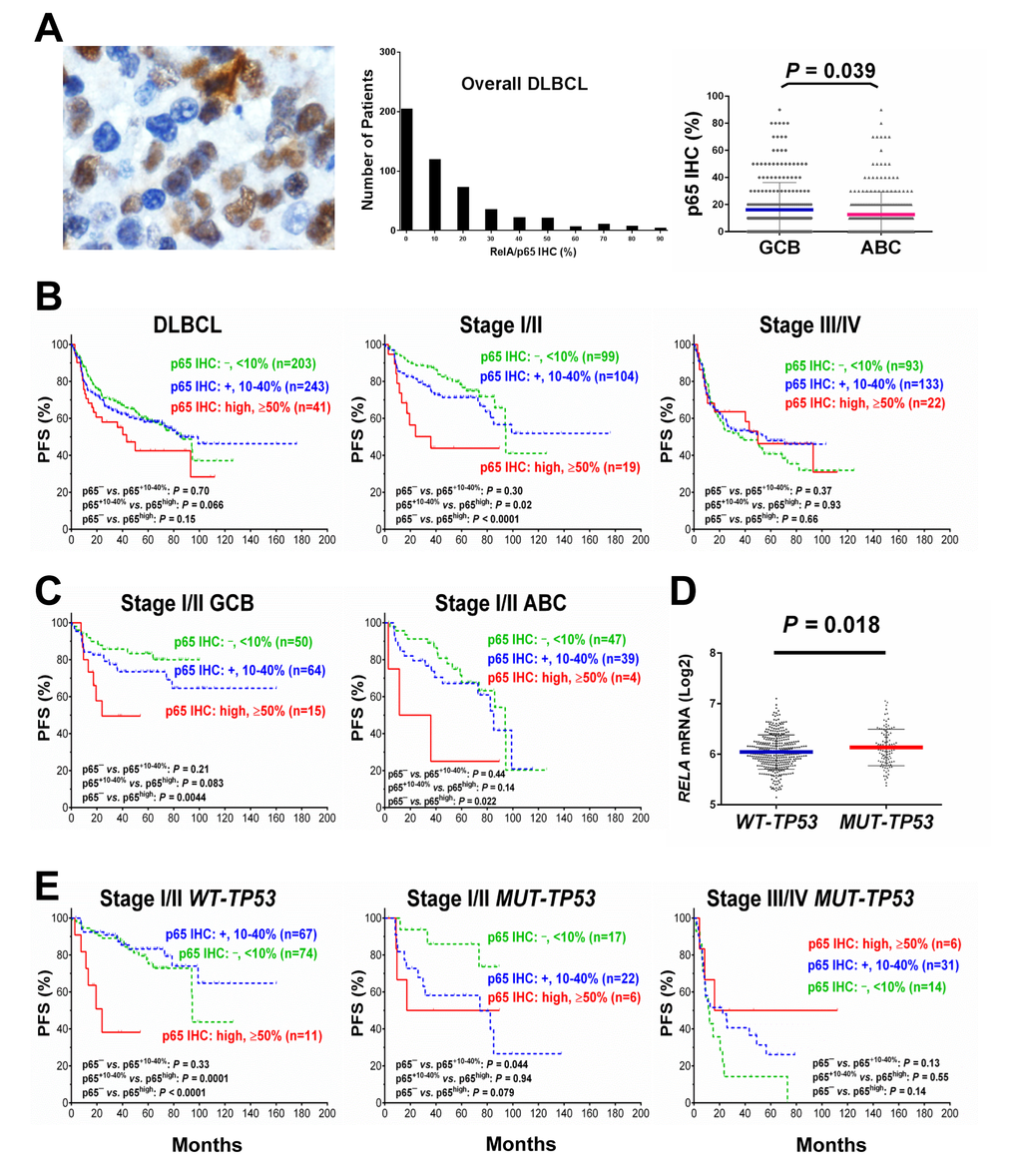 Nuclear expression of p65 and its effect on progression-free survival (PFS) in diffuse large B-cell lymphoma (DLBCL) (A) Representative immunohistochemical analysis (IHC) and histograms for p65 nuclear expression in DLBCL. The mean expression of nuclear p65 was significantly higher in the germinal center B-cell–like (GCB) subtype than in the activated B-cell–like (ABC) subtype. (B) In overall DLBCL, high p65 nuclear expression (p65high, ≥50% nuclear expression) was associated with a trend towards worse PFS. In patients with stage I/II DLBCL, p65high correlated with significantly shorter PFS. In patients with stage III/IV DLBCL, p65high did not show signficant prognostic impact. (C) p65high correlate with significantly shorter PFS in patients with stage I/II DLBCL independent of GCB/ABC subtypes. (D) TP53 mutation status was significantly associated with higher RELA mRNA expression. (E) In patients with stage I/II DLBCL, p65high correlate with significantly shorter PFS independent of TP53 mutation status although more significant in patients with wild-type TP53 (WT-TP53). In patients with mutated TP53 (MUT-TP53) and stage III/IV DLBCL, p65high was associated with a trend of better PFS.