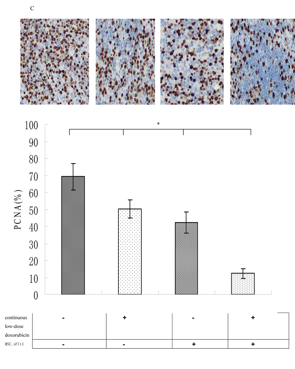 Immunohistochemical detection of PCNA protein expression (brown color) of saline group, continiuous low-dose doxorubicin group, MSC.sFlt1 group and MSC.sFlt1 plus continuous low-dose doxorubicin group. Combination therapy enhanced the inhibition of tumor cell proliferation in vivo. Magnification, 200×. Data from 3 independent experiments are shown. *p 