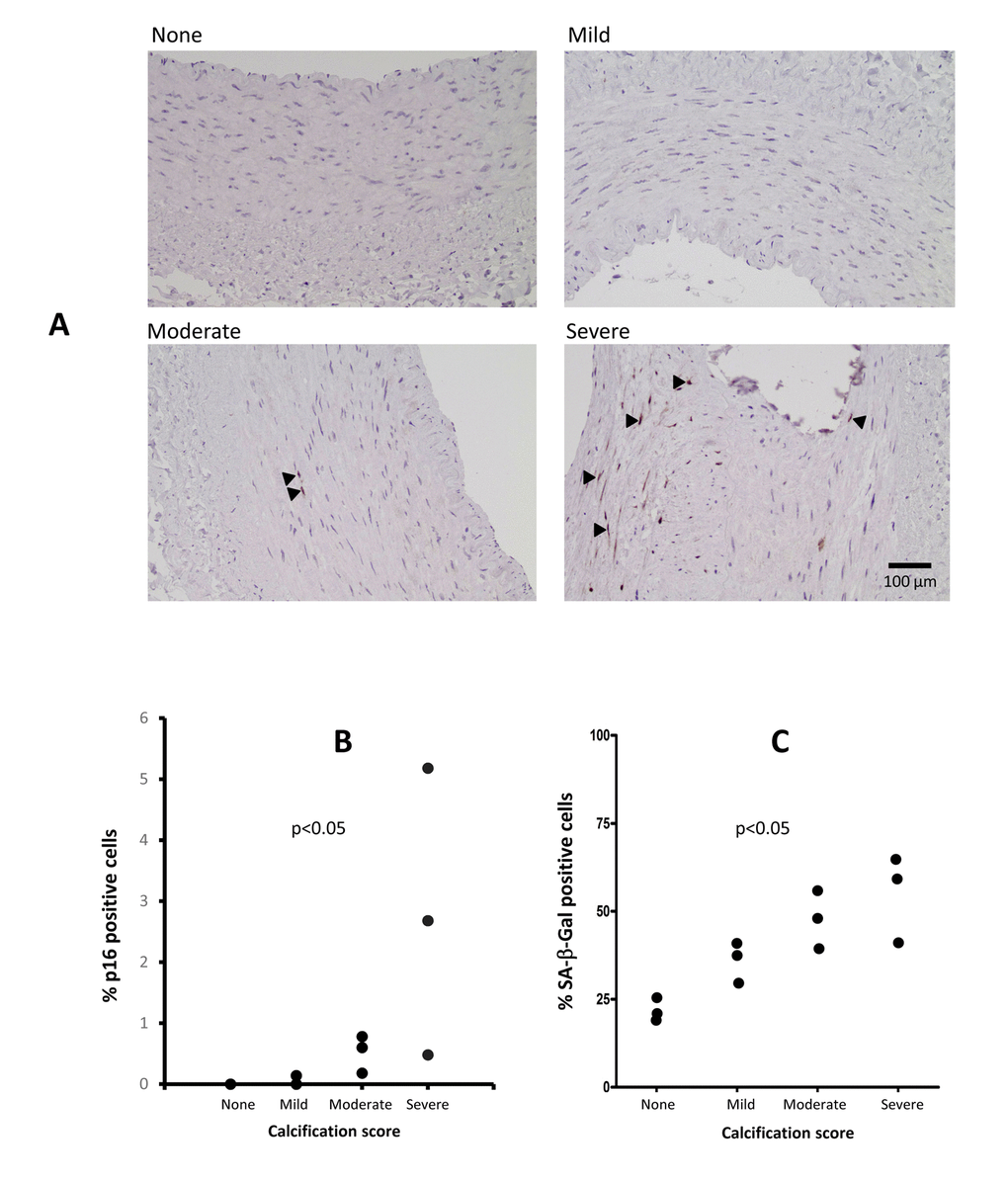 Immunostaining of arterial p16INK4a and SA-β-Gal in patients with varying degrees of vascular calcification (VC) (A). The p16INK4a expression was localised to the cell nucleus and involved more cells in severe VC. Staining for p16INK4a with DAB (brown) and counterstaining with hematoxylin (blue). Arrowheads indicate p16INK4a positive cells. (B) Levels of p16INK4a in epigastric arteries from patients with varying degrees of VC, expressed as the percentage of p16INK4a positive cells of total number of cells in the media and intima layers in a single arterial section (n=2 for no VC, n=3 for mild VC, n=3 for moderate VC and n=3 for severe VC). The number of positive SA-β-Gal positive cells increase with increased calcification (C); no VC; n=2, mild VC; n=3, moderate VC; n=3 and severe VC; n=3. P-values represent no vs. severe VC.