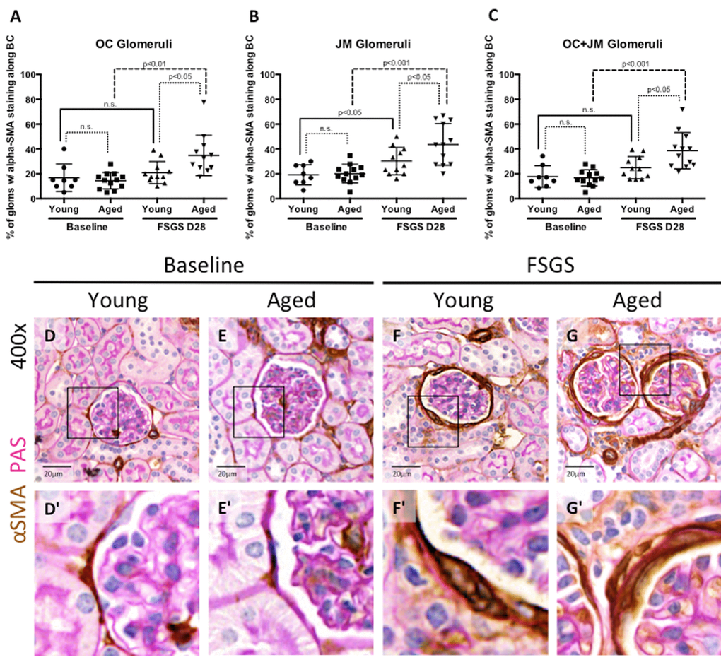 EMT marker staining along Bowman’s capsule was highest in aged FSGS mice. (A-C) Quantitation showing the percentage of glomeruli with α-SMA (EMT marker) staining along BC. There was no significant difference in young and aged mice at baseline in OC (A), JM (B), or combined (C) glomeruli. In OC (A), JM (B), and combined (C) glomeruli, α-SMA staining increased with disease in aged animals, while only in the JM (B) was α-SMA staining significantly increased in young mice, likely due to large variation within the sample groups. (D-G) Representative images of glomeruli with alpha-SMA staining along BC taken at 40x. Frequency and intensity α-SMA staining increased with disease (D vs. F, E vs. G), despite similar levels between young and aged animals at baseline (D vs. E). (D’-G’) Higher power images of the area demarcated by the solid square shown above, emphasizing the increase in α-SMA staining of cells along BC (F’, G’).