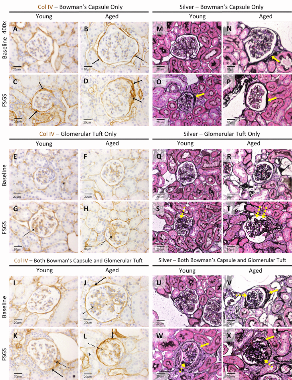 Extracellular matrix accumulation was higher in Bowman’s capsule of aged FSGS mice. (A-L) Collagen IV (Col IV) staining. Representative images taken at 40x of Col IV staining (brown color) along Bowman’s capsule only (A-D, solid arrows), glomerular tuft only (E-H, dashed arrows), or along Bowman’s capsule and the glomerular tuft (I-L, solid and dashed arrows respectively). (M-X) Jones’(Silver) staining. Representative images taken at 40x of Jones’ basement membrane staining along BC only (M-P, yellow solid arrow), in the glomerular tuft only (Q-T, dashed yellow arrow), and both along BC and in the tuft (U-X, solid and dashed yellow arrows respectively) confirmed the staining patterns of Col IV.