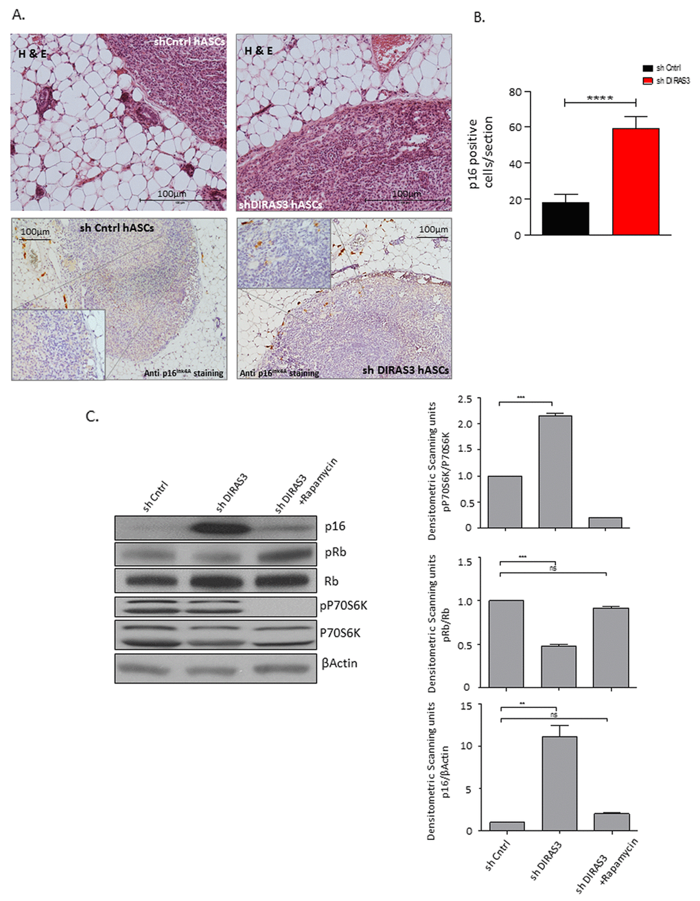 Human DIRAS3 KD ASCs develop a senescence phenotype in posterior sWAT of SCID mice. (A) (Upper panel) Human shDIRAS3 ASCs (shDIRAS3 hASCs) and shCntrl hASCs were xenotransplanted into posterior sWAT of SCID mice. Injection sites of hASCs were histologically identified and marked by H&E staining. (Lower panel) Senescent DIRAS3 KD hASCs were detected by immunohistochemical staining using anti p16INK4A antibodies. Region of Interest (ROI) is shown in higher magnification. (B) Number of p16INK4A positive hASCs per section were counted and plotted (n = 5 per group). (C) (Left panel) Cell lysates from control ASCs and DIRAS3 KD ASCs cultured with and without 20 nM rapamycin were blotted for p16INK4A, Rb, pRb (S807/811), P70S6K and pP70S6K (T389) using specific antibodies. β-Actin served as loading control. Note, rapamycin was added 2 days after virus infection. (Right panels) Fold changes in densitometric band intensities presented as Arbitrary Units (AU) for phosphorylated proteins normalized to un-phosphorylated total proteins, acquired by image J were compared. Band intensity of shCntrl was taken as 1 (n=2). All error bars represents the means ± SEM. p values * = p