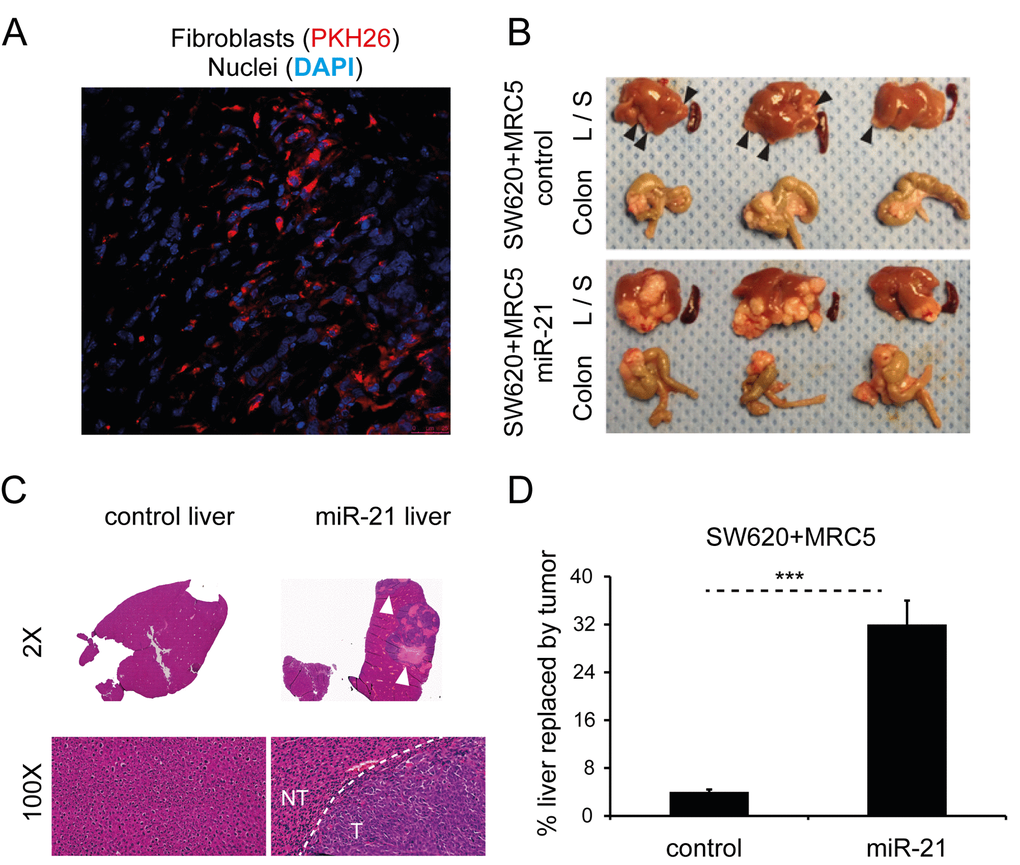 Stromal miR-21 leads to tumor progression in an in vivo orthotopic CRC model. (A) Confocal microscopy of tumor section generated by subcutaneous co-injection of PKH26-labeled MRC5 fibroblasts (red) and CRC cells, counterstained with DAPI (blue; 60x). (B) Liver (L), spleen (S) and colon from mice orthotopically injected with SW620 CRC cells and MRC5 control or miR-21-overexpressing fibroblasts. Arrowheads highlight liver metastases. The effect of miR-21-overexpressing cells was to increase the size and number of liver metastases. No splenic metastases were seen in either group. (C) Representative liver sections at 2x and 100x magnification. Bulky hepatic metastases are evident in the SW620/MRC5-miR-21 liver (arrowheads; 2x) with a clear histological demarcation between normal liver and metastatic tumor (NT – normal tissue, T – tumor; 100x). (D) Percentage liver replacement by metastatic tumor in SW620/MRC5-control (control) and SW620/MRC5-miR-21 (miR-21) mice. Data is presented as mean +/- SEM. Student’s t-test: *** p