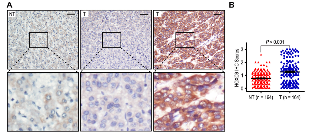 HOXC6 was overexpression in hepatocellular carcinoma samples. (A) Immunohistochemistry assays of HOXC6 expression in HCC tissues and adjacent non-tumorous tissues. The upper left panel represents low HOXC6 expression in adjacent non-tumorous tissues. The upper middle and right panel represents low and high HOXC6 expression in HCC tissues. Lower panels represent magnified pictures of boxed area in the corresponding upper panels. The line scale bar represents 50 μm. (B) HOXC6 expression in HCC was compared with that in adjacent non-tumorous specimens. Statistical analysis was performed by Paired-Samples t-test.
