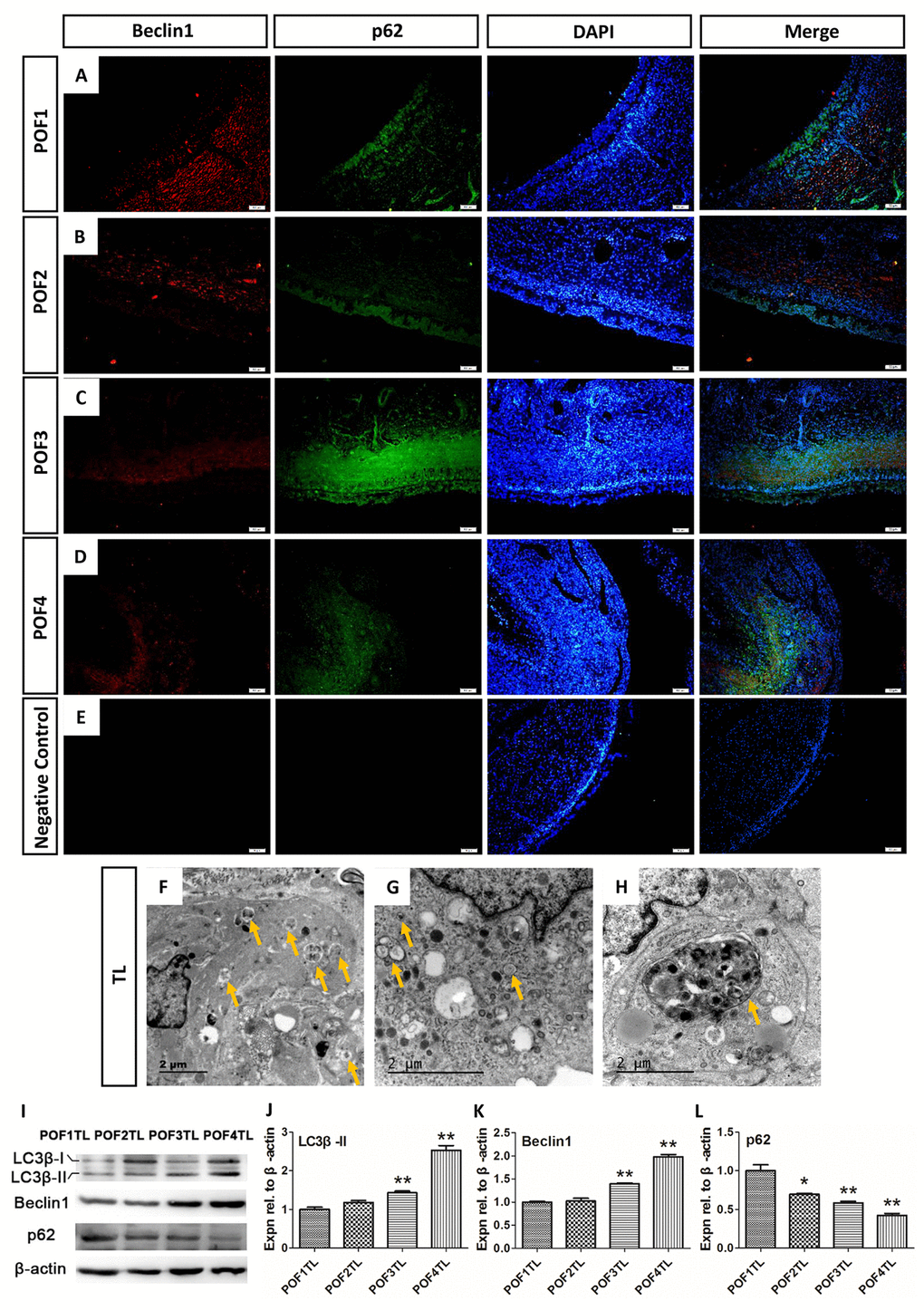 Autophagy mainly occurred in the theca layer of the POFs. (A-D) Histological sections of POFs (POF1-POF4) were given an immunofluorescent label with the autophagy marker Beclin1 (Red), which was mainly distributed in the theca layer, and p62 (Green). Scale bar: 50 μm. (E) Negative Control. (F-H). TEM was used to observe the large amounts of autophagosomes and autolysosomes existing in the theca layer of the POFs (arrows). (I-L) WB and grey analysis of LC3β-II, Beclin1 and p62 expression in POFs (POF1 to POF4). TL represents the theca layer. Values are means ± SEM of three experiments. Asterisks indicate significant differences (* PP