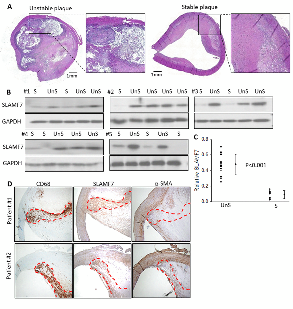 SLAMF7 expresses significantly higher in the UnS plaques than in the S plaques. (A) Representative histological H&E staining of UnS and S plaques in our study. (B) Protein expression of SLAMF7 was evaluated in the total of 15 UnS and 10 S plaques. Western Blot analyses were performed in 5 batches (#1-5) when patients were enrolled consecutively, GAPDH was used as internal control. (C) Quantification of the SLAMF7 expression in UnS vs. S plaques of the Western Blot. PD) Serial tissue sections from 2 individual patients were stained with anti-CD68, SLAMF7 and α-SMA antibodies. Red dash line segmented CD68+ macrophage area.