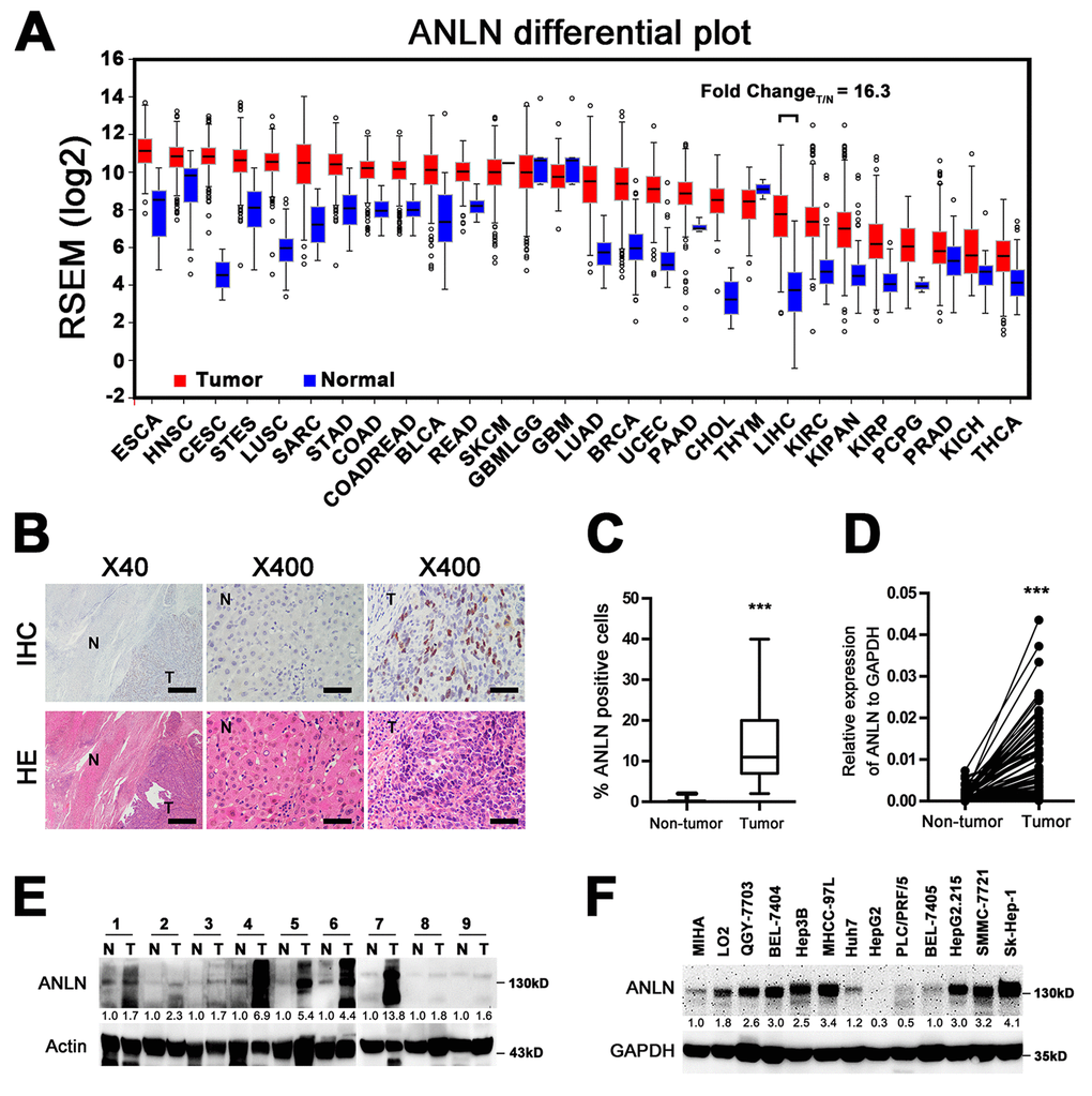 ANLN is highly expressed in hepatocellular carcinoma. (A) The mRNA levels of ANLN in global human cancer tissues (red) and non-tumor tissues (blue) were analyzed using the TCGA database (<a href="http://firebrowse.org/" target="