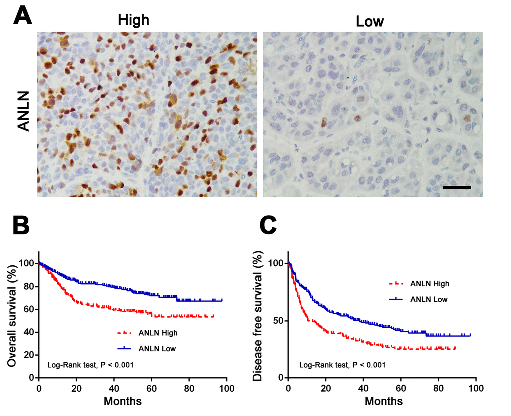 Upregulation of ANLN is associated with a poor prognosis in human HCC. (A) Representative images of IHC staining of high and low ANLN expression in HCC tissue. Scale bar: 50 μm. (B-C) ANLN expression was associated with overall survival (B) and disease-free survival (C) in our HCC cohort according to Kaplan-Meier analysis. ANLN high: 164 samples; ANLN low: 272 samples.
