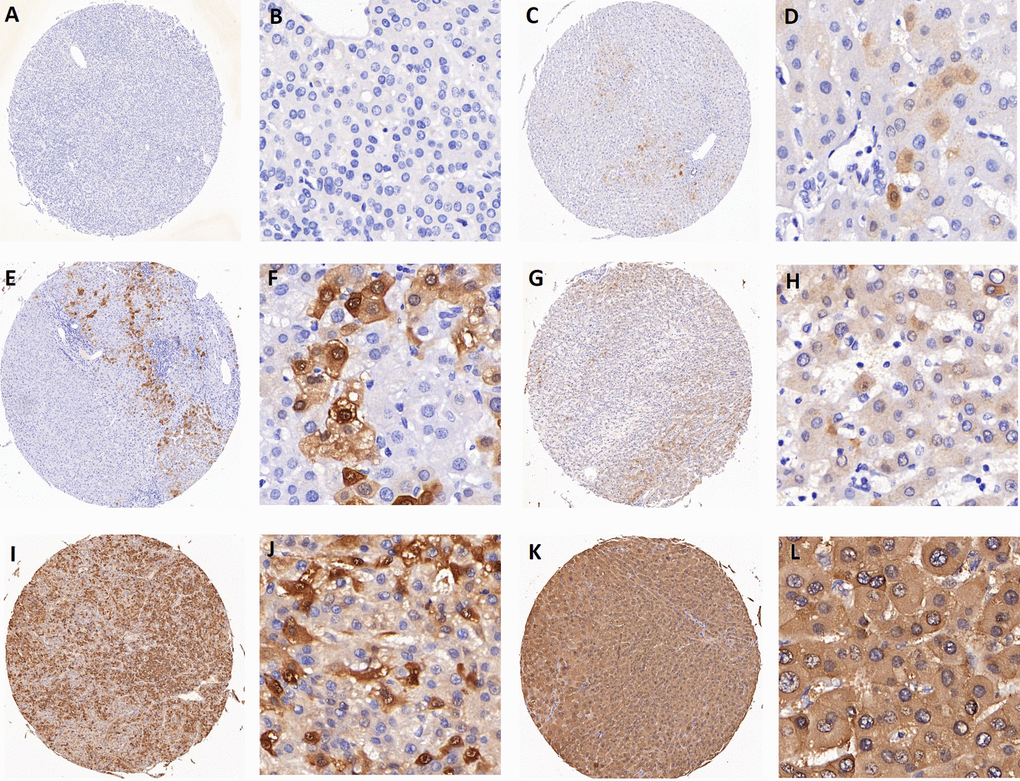 Representative images of AKR1B10 immunohistochemistry staining in tissues. (A-B) represent negative staining (score: 0). (C-D) (score: 1), (E-F) (score: 2), (G-H) (score: 4) all represent weak staining. (I-J) (score: 6) and (K-L) (score: 8) represent strong staining. Scores 0 to 4 are categorized as low expression of AKR1B10, while scores 6 to 8 are considered as high expression.