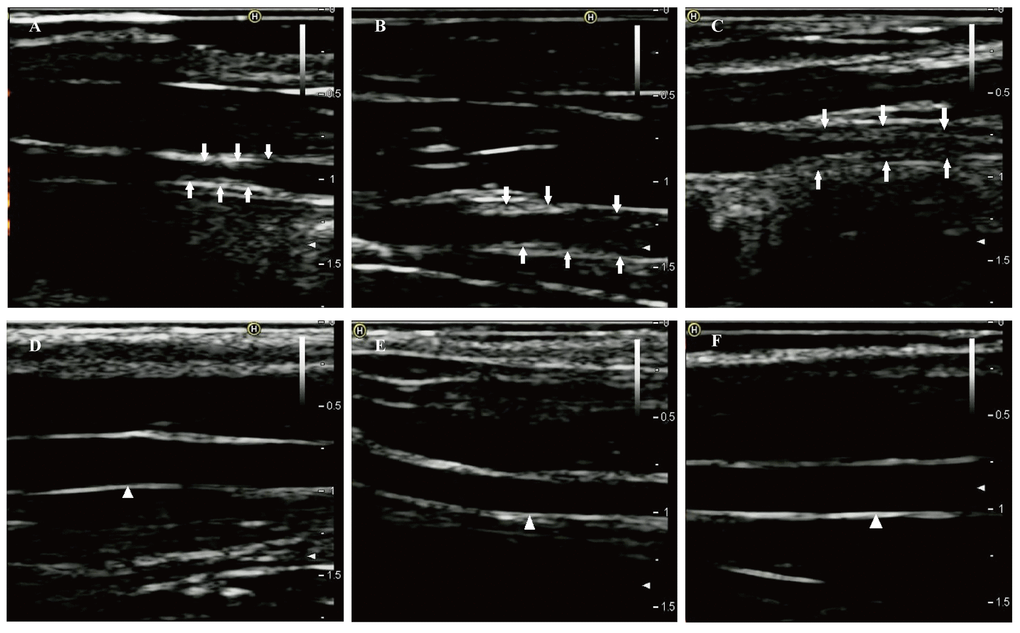 Two-dimensional ultrasound of right common carotid arteries at eighth week. (A-C) Two-dimensional ultrasound images show that the right common carotid arteries in the case group formed obvious atherosclerotic plaques indicated by the arrows. (D-F) Two-dimensional ultrasound images clearly show that the intimas of the right common carotid arteries in the control group remain smooth (white triangle).