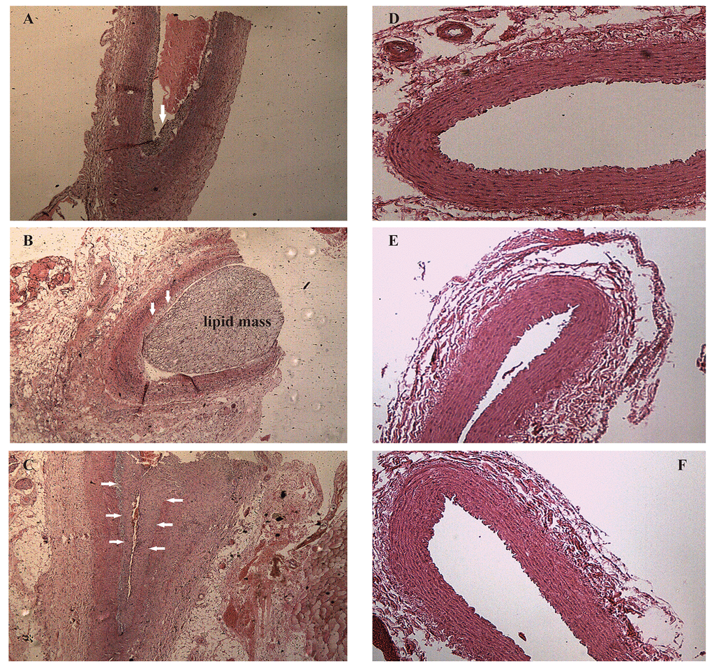 Hematoxylin and eosin staining of right common carotid arteries. (A-C) Hematoxylin and eosin stained vessels reveal plaques of different severities in the carotid arteries of the case group, ×40 (arrows). (D-F) Hematoxylin and eosin stained vessels show that the carotid arteries in the control group without obvious abnormalities, ×40.