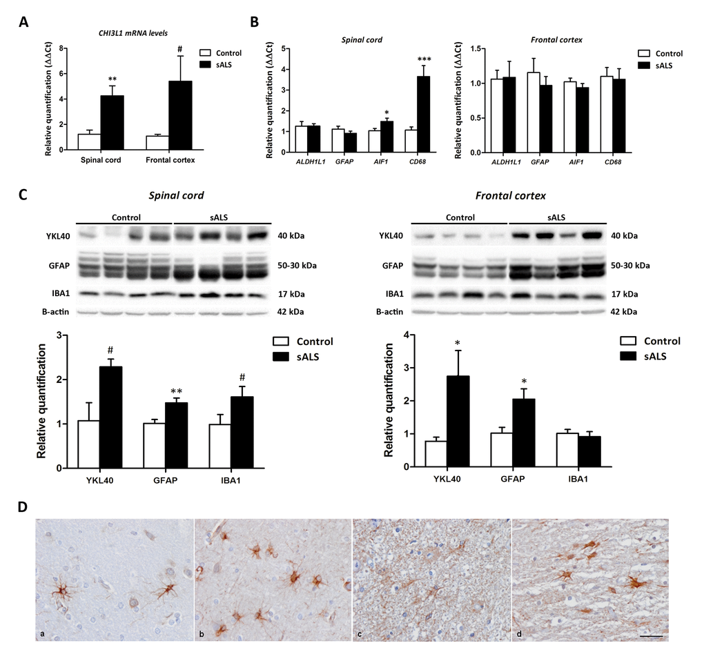 (A) CHI3L1 mRNA expression levels in the anterior horn of the lumbar spinal cord and frontal cortex area 8 in sALS and control cases. CHI3L1 is significantly up-regulated in the anterior spinal cord but has only a tendency to increase without significance in the frontal cortex in sALS compared with controls. (B) mRNA expression levels of microglial (CD68 and AIF1) and astroglial (GFAP and ALDH1L1) markers in the anterior horn of lumbar spinal cord and frontal cortex area 8 in sALS and age-matched controls. Microglial markers CD68 and AIF1 are significantly up-regulated in the anterior horn of the spinal cord but not in the frontal cortex in sALS. The mRNA expression levels of astroglial markers in the spinal cord and frontal cortex are not modified in pathological cases when compared with controls. (C) Western blot analysis of YKL40 in the spinal cord (left panel) and frontal cortex area 8 (right panel) of control and sALS; β-actin was used for normalization. Graphical representation of western blot data; fold changes in the expression of protein are determined relative to the control cases. YKL40 and GFAP protein levels are increased in the spinal cord and frontal cortex in sALS when compared with controls. Due to individual variation, increased values in the anterior horn of the spinal cord showed only a tendency without statistical significance. In contrast, expression levels were not significantly modified in sALS. *P P P PD) YKL40 expression in frontal cortex area 8 (a, b) and spinal cord (c, d) in control (a, c) and sALS (b, d) cases) is found in astrocytes; immunohistochemical sections lightly counterstained with haematoxylin, bar = 25μm.