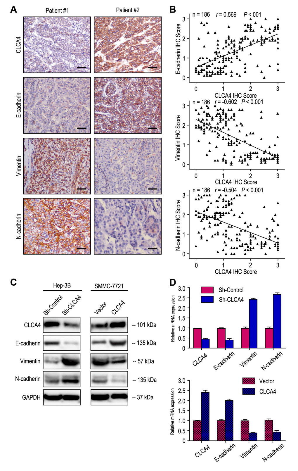 CLCA4expression was correlated with the expression of epithelial-mesenchymal transition (EMT) markers. (A) Serial sections of human HCC tissue were subjected to IHC staining with antibodies against CLCA4, E-cadherin, Vimentin and N-cadherin. In patient #1, low CLCA4 expression in HCC tissues was accompanied by the absence of E-cadherin and elevated Vimentin, N-cadherin. In patient #2, high CLCA4 expression was accompanied by elevated E-cadherin and the absence of Vimentin, N-cadherin. The scale bar represents 50 μm. (B) CLCA4 expression was positively associated with E-cadherin expression and negatively correlated with vimentin and N-cadherin expression. (C) Decreased expression of E-cadherin with increased expression of Vimentin and N-cadherin in CLCA4-silenced cells compared with the control cells. An opposite expression pattern of these genes was observed in CLCA4-transfected cells. (D) The mRNA of E-cadherin was down-regulated, while the vimentin and N-cadherin was up-regulated, when CLCA4 was silenced. And opposite expression was observed in CLCA4-transfected cells.