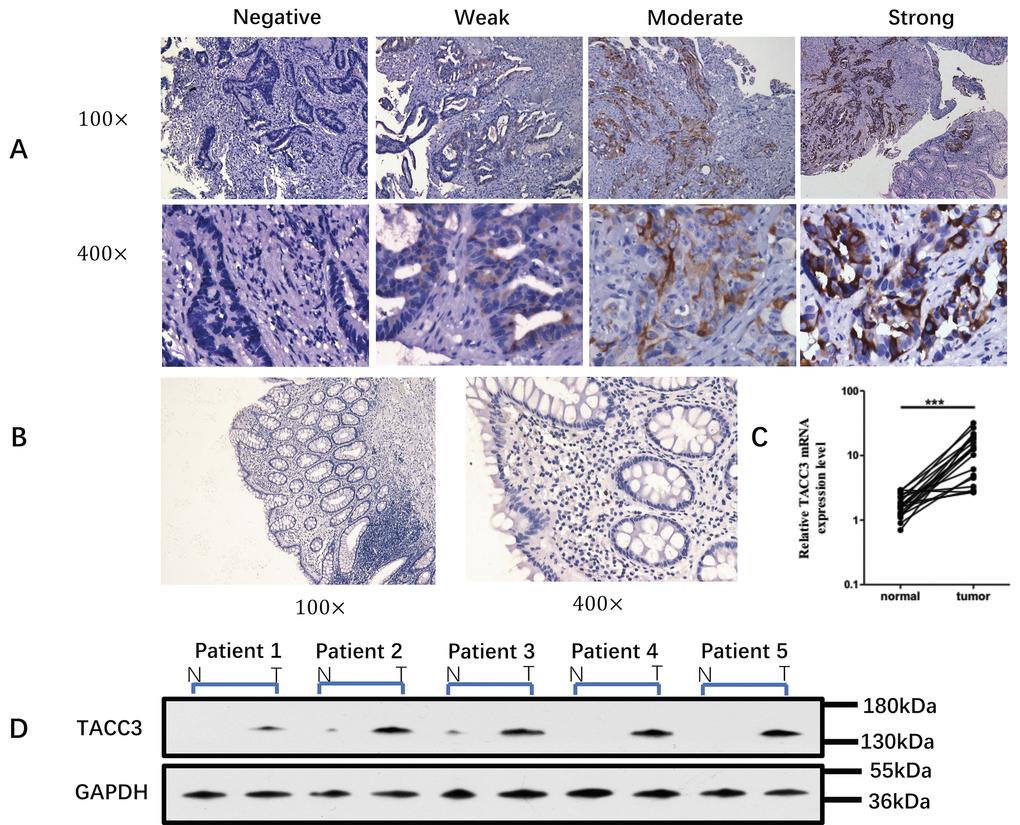 TACC3 expression in biopsy samples. (A) Expression of TACC3 protein in biopsy tumor tissue and normal tissue from 152 rectal cancer patients before neoadjuvant CRT. The level of TACC3 expression was classified as negative, weak, moderate or strong. (Immunohistochemical staining, 100× and 400×). (B) Expression of TACC3 in normal rectal tissue (Immunohistochemical staining, 100× and 400×). (C) Levels of TACC3 mRNA in rectal cancer tissue and normal tissue from 20 patients. (D) Western blot of biopsy tissue from five rectal cancer patients before neoadjuvant CRT.