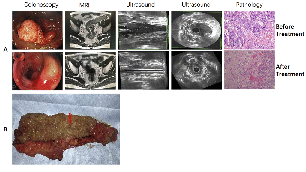 Typical sensitive rectal cancer patient who received CRT and achieved pCR. (A) colonoscopic, MR, ultrasound and pathological imaging before and after neoadjuvant CRT. (B) Gross surgical specimen from this patient.