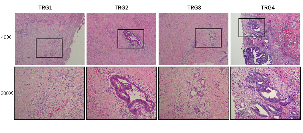 Assessment of tumor regression. Using AJCC tumor regression grading (TRG), tumors were classified into four histological tumor regression grades based on the amount of vital tumor tissue and the ratio of fibrosis as follows: TRG 0, complete regression and absence of viable cancer cells; TRG 1, presence of only small clusters or single cancer cells; TRG 2, presence of residual cancer cells but with predominant fibrosis; and TRG 3, minimal or no decrease in tumor cells or extensive residual cancer.