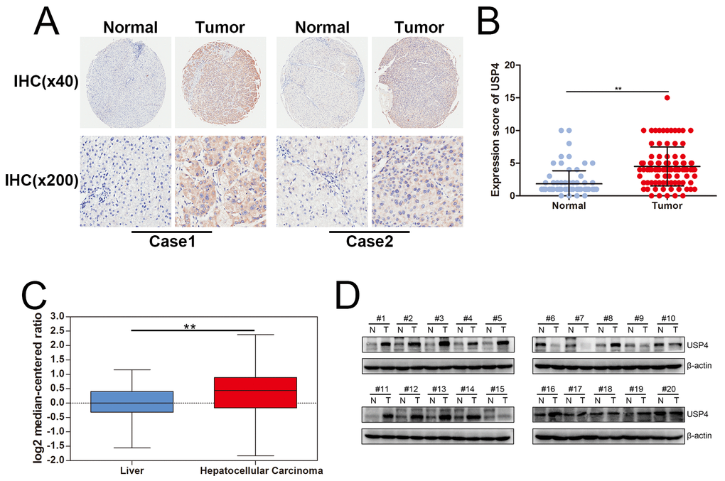 USP4 expression was significantly upregulated in HCC. (A) USP4 expression in HCC tumor tissues and matched surrounding tissues were examined by immunohistochemical staining. (magnification, ×40 and ×200). (B) Immunohistochemical scores of USP4 expression in HCC tumor tissues and matched surrounding tissues (** P C) The mRNA level of USP4 in normal liver tissues and HCC tumor tissues which were collected from Oncomine data base (** P D) USP4 expression in fresh HCC tumor tissues and matched surrounding tissue were examined by western blotting (N, matched surrounding tissues, T, tumor tissues).