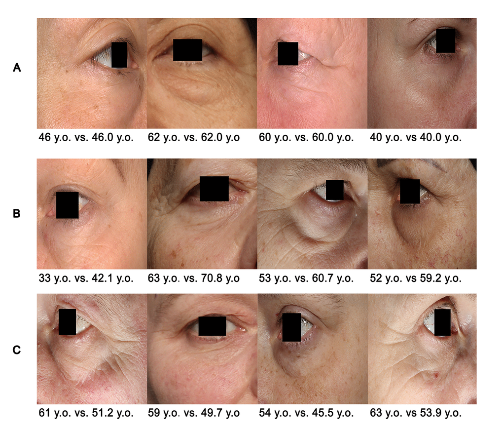 Examples of PhotoAgeClock performance. (A) Cases when the trained model produced the lowest errors on the test set. (B) Cases when the trained model overestimated age the most on the test set. (C) Cases when the trained model underestimated the age the most on the test set. True vs. predicted age is labeled. Eye areas were erased for anonymity purposes but were present in the actual dataset pictures.