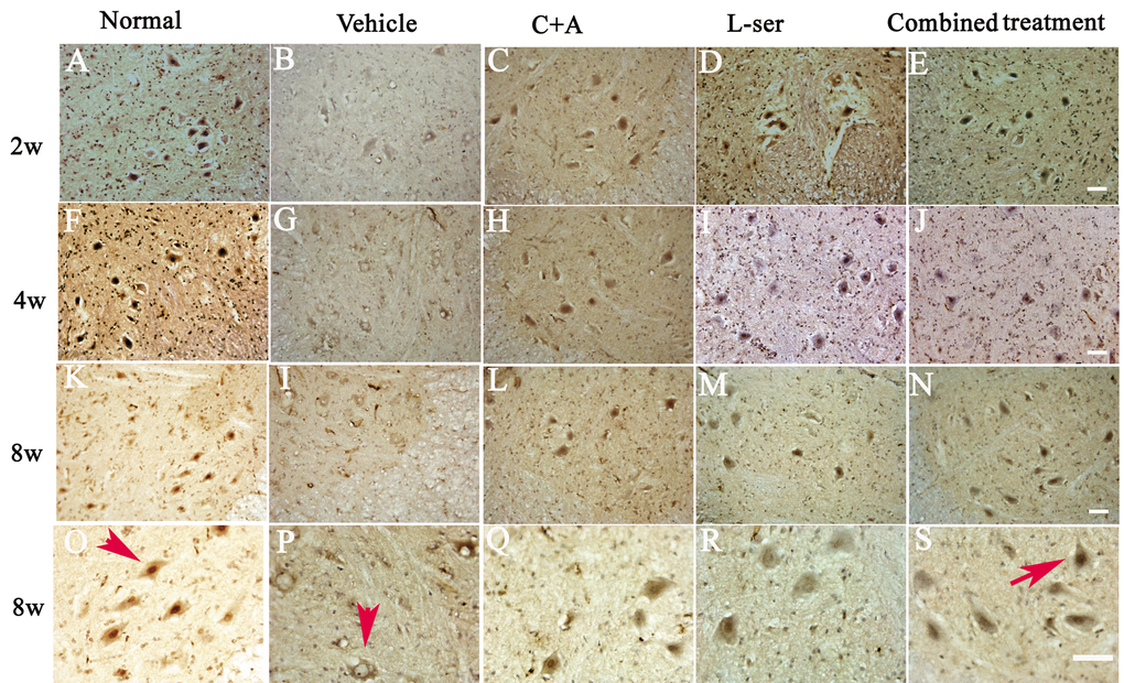 L-BMAA injections stimulated the emergence of cytosolic TDP-43 immunoreactive aggregates in spinal cord motor neurons. Scale bar = 100 μm. In the motor neurons of normal control rats, TDP-43 expression was primarily confined to the nucleus (indicated by the arrow in O). However, approximately 6 weeks after L-BMAA injection, a decline in the distinct nuclear expression of TDP-43 was accompanied by the emergence of cytosolic staining in a proportion of degenerating motor neurons. By 8 weeks after L-BMAA injection, a pronounced decline in TDP-43 expression in the nuclei of damaged motor neurons was observed (indicated by the arrow in P), and the nuclei showed a bulging and vacuolated morphology. With C16+Ang-1 or L-serine treatment, the TDP-43 labeling in large motor neurons was mainly localized in the nuclei compared with that in the control group, and this phenomenon was more visible in the combined treated group (shown by the arrow in S).