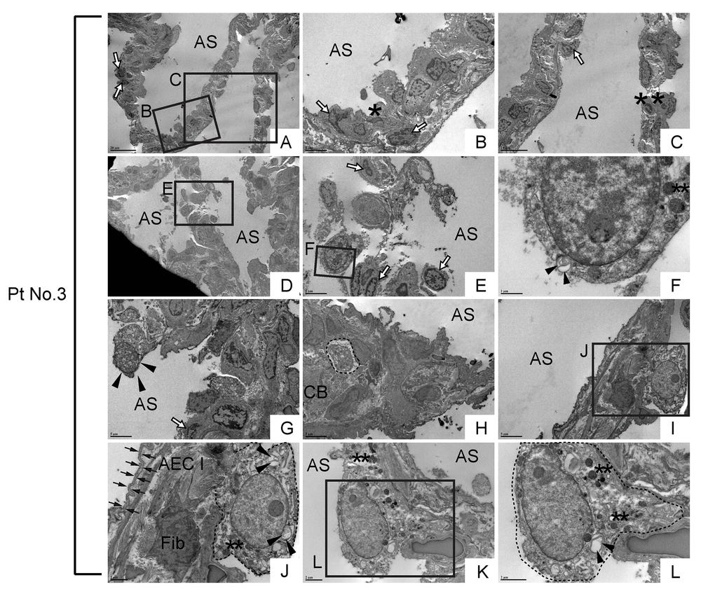 Morphologically abnormal type II alveolar epithelial cells with similar subcellular structures to metaplastic bronchiolar epithelial cells are encountered in alveoli of IPF lung. TEM was performed on human IPF samples from patient No. 3. Labeled boxes correspond to their respective enlarged images. (A-E) Alveolar regions with slight interstitial fibrosis show random distribution of cells with varying degrees of apoptosis. Cells with highly condensed chromatin, which are considered to be at late stages apoptosis, are designated by asterisks while cells exhibiting narrow cytoplasm and marginal condensation of chromatin, which are considered to be at early stages of apoptosis, are designated by open arrows. (F) Floating in airspace is a highly atypical cell featuring high nucleus-to-cytoplasm (N/C) ratio, dysmorphic lamellar body (arrowheads) and granular structures suspected of either secretory granules or degraded mitochondria (double asterisks). Note the appearance of cytoplasm and cytoplasmic membrane reminds loss of cell viability meanwhile the nucleus does not show the features of apoptosis. (G) A highly atypical cell with a lot of granular structures is barely attached to the alveolar tissue as if it has migrated and just landed on alveolar tissue. (H) A suspected epithelial cell type (circled by dashed line) featuring microvilli and dysmorphic lamellar bodies, quite similar to the highly vacuolated bronchiolar epithelial cells seen in bronchiolar region (arrows in Fig. 11M). (I-L) Metaplastic epithelial cells suspected of either type II AECs or progenitor cells committed to type II AECs (circled by dotted line) featuring dysmorphic lamellar bodies (arrowheads), granular structures, slightly euchromatic nucleus and vacuolated cytoplasm. Note the juxtaposition of collagen producing active fibroblast (Fib) with a metaplastic epithelial cell with type II AEC morphology (Panel J), which suggests epithelial-to-mesenchymal interaction. Type I AEC (arrows in Panel J) across the active fibroblast from metaplastic epithelial cell show relatively intact appearance. AS: Airspace; AEC I: type I alveolar epithelial cell; CB: Collagen Bundle; Fib: Fibroblast. *(single asterisk) = Apoptotic cell, **(double asterisks) = Granular structures suspected of secretory granules or degraded mitochondria. Magnifications: (A and D) 1200X; (B, E, G, H & I) 4000X; (C) 2500X; (F) 20000X; (J and K) 8000X; (L) 12000X.