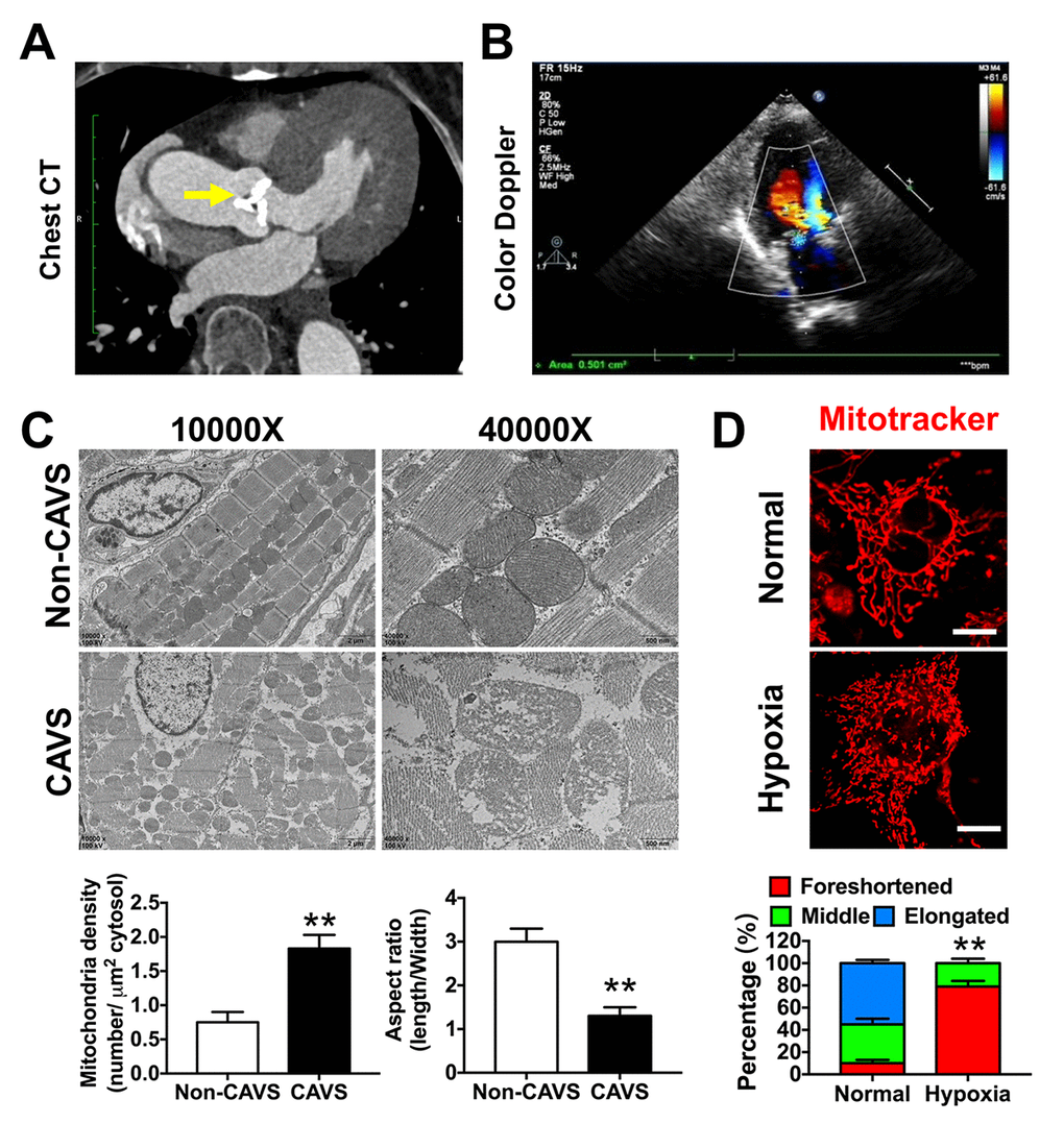 Mitochondrial dysfunctions after myocardial ischemia in CAVS patients. (A) The chest CT of the CAVS patient. The yellow arrow refers to the calcified aortic valve; (B) The cardiac multifunctional color Doppler ultrasound image of the CAVS patient; (C) The electronic microscopy observation of mitochondria in CAVS myocardial tissues; (D) Confocal microscopy observation of mitochondrial morphology in H9C2 hypoxic simulated myocardial ischemia, bar=10μm. Quantitation is done in triplicate and scored into three categories: foreshortened, middle and elongated mitochondria. *P