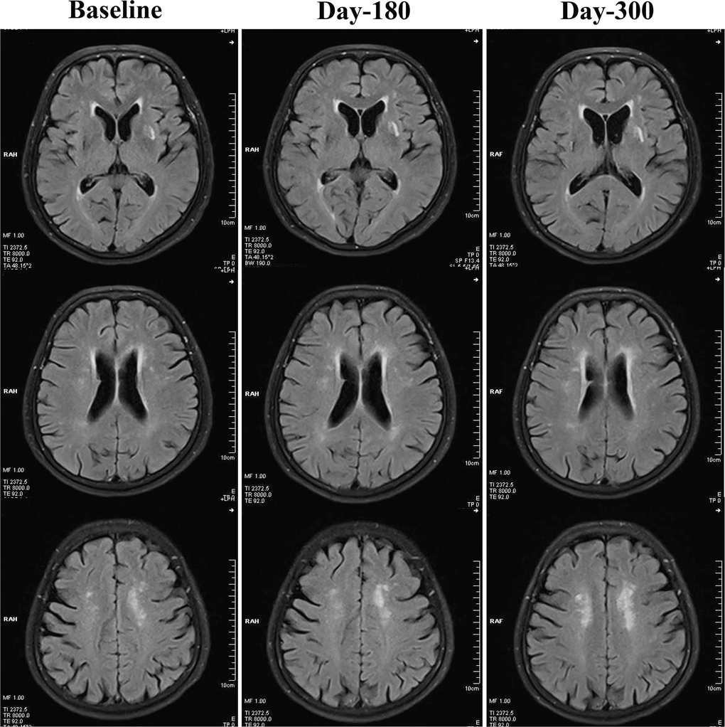 Changes of WMHs in the control group from baseline, day 180 to day 300. In the control group, WMHs were not significantly attenuated at day 180 or day 300, when compared with baseline levels. By contrast, WMHs seemed to be increased robustly at day 300.