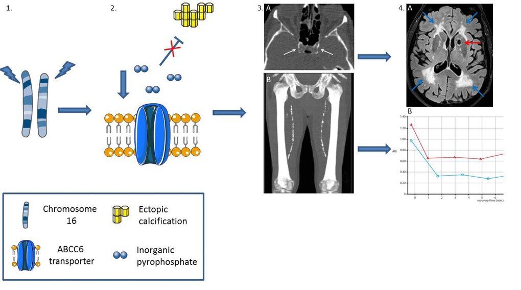 Peripheral vascular aging in pseudoxanthoma elasticum: mutations in the ABCC6 gene on chromosome 16 (1), which encodes the ABCC6 transporter, result in low levels of inorganic pyrophosphate, a strong inhibitor of ectopic calcification (2). The subsequent peripheral artery calcification in the carotid siphon (3A, white arrows) results in lacunar infarctions (4A, red arrow) and white matter lesions (4A, blue arrows). Calcification of the femoral arteries (3B) results in peripheral arterial disease (PAD). 4B shows decreased ankle brachial index (ABI) of the left (blue line) and right (red line) leg after treadmill test, diagnostic for PAD.