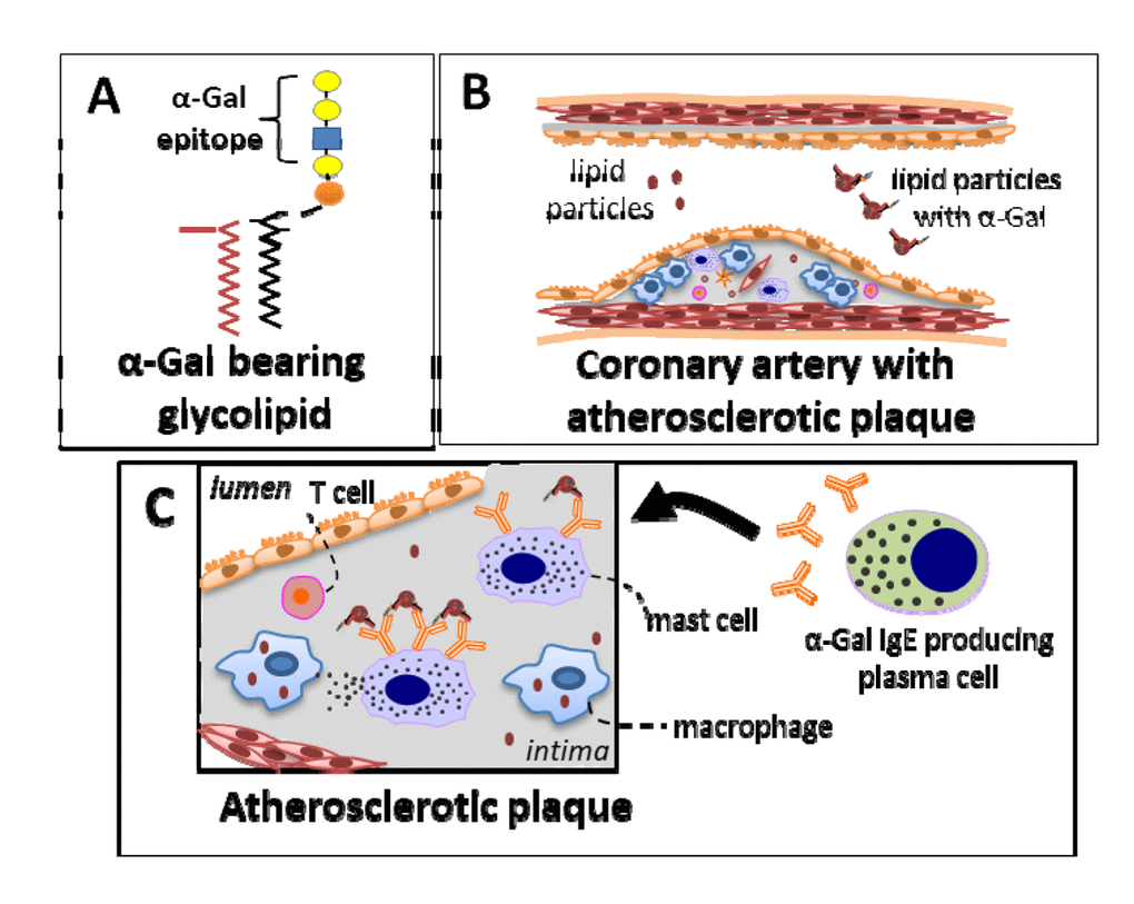 Proposed model to explain the relationship between IgE sensitization to α-Gal and CAD. The hypothesized relationship involves an interaction between a specific IgE immune response to α-Gal and dietary consumption of α-Gal-bearing glycolipids. (A) Representative depiction of a glycolipid with an α-Gal epitope. Such glycolipids are present in red blood cell membranes, muscle, fat and secretions of non-primate mammals. (B) Dietary lipids are absorbed through the intestinal epithelium and packaged into lipoprotein particles. Initially this involves chylomicrons before passing to smaller particles such as LDL or HDL that can subsequently deliver α-Gal epitopes to peripheral tissue where mast cells reside. Importantly, this can include mast cells within atherosclerotic plaques. (C) Specific IgE are bound to mast cells, including IgE specific to α-Gal, in subjects who are sensitized to the oligosaccharide, and thus α-Gal from dietary exposure could bind to and activate signal transduction via the high-affinity IgE receptor (Fc εR1). Relatively low levels of α-Gal exposure may be insufficient to induce mast cell degranulation, and thus not lead to overt allergic symptoms such as hives or anaphylaxis, but could nonetheless lead to chronic mast cell activation and pro-inflammatory effects.