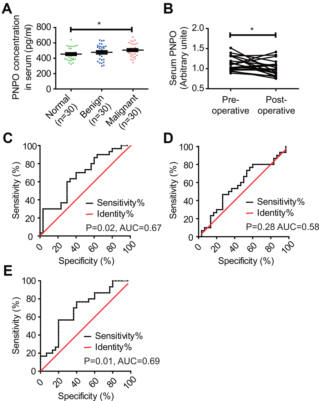 Detection of serum PNPO concentration and calculation of receiver operating characteristic (ROC) curves. (A) Measurement of PNPO concentration in the peripheral blood of women without tumor (Normal) and patients with fibroadenomas (Benign) or IDC (Malignant). * P B) Relative PNPO levels in matched serum samples from IDC patients before (Pre-operative) and after (Post-operative) surgery. * P C) ROC curves for the identification of breast IDC patients vs. non-cancer patients (n = 30, respectively) based on the concentration of PNPO in serum (P D) ROC curves for the identification of breast IDC patients vs. non-cancer patients (n = 30, respectively) based on the concentration of COL5A1 in serum (P > 0.05). (E) ROC curves for the identification of breast IDC patients vs. non-cancer patients (n = 30, respectively) based on the concentration of PNPO and COL5A1 in serum (P 