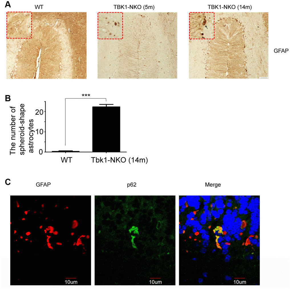 Astroglial alterations induced by Tkb1 deficiency. (A) GFAP immunostaining of the cerebellum of 5 and 14 months old mice (n = 3). Bar = 50 μm. Spheroidal astrocytes are indicated by arrows. (B) Quantification of astrocyte degeneration (n = 9); ***P C) Double GFAP and p62 immunofluorescence of the cerebellum. Bar = 10 μm.