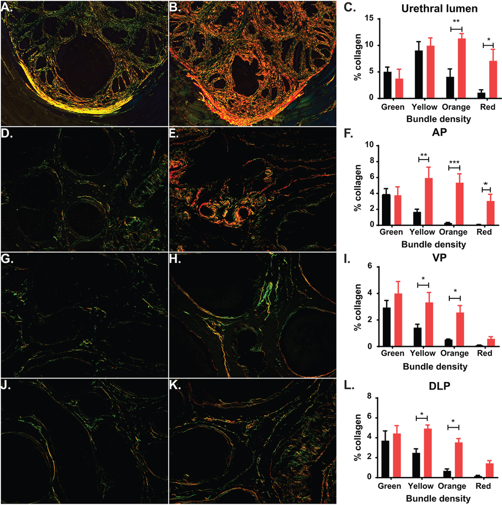 Aging leads to changes in collagen deposition. (A) Representative image of picrosirius red (PSR) staining of prostatic urethra specifically around the urethral lumen show predominantly green and yellow collagen fibers in young mice. (B) Representative image of PSR staining show predominantly orange and green collagen fibers in aged mice. (C) Quantitation of collagen fibers in the prostatic urethra show a statistical increase of orange and red collagen bundles in aged mice. (D) Representative image of PSR staining show predominantly green collagen fibers within the AP of young mice. (E) Representative image of PSR staining show predominantly yellow, orange, and red collagen bundles within the AP of aged mice. (F) Quantitation of collagen fibers within the AP shows a statistical increase in yellow, orange, and red collagen bundles and an overall increase in total collagen in aged mice. (G) Representative image of PSR staining show predominantly green collagen fibers within the VP of young mice. (H) Representative image of PSR staining show predominantly yellow and orange collagen bundles within the VP of aged mice. (I) Quantitation of collagen fibers within the VP shows a statistical increase in yellow and orange collagen bundles and an overall increase in total collagen in aged mice. (J) Representative image of PSR staining show predominantly green collagen fibers within the DLP of young mice. (K) Representative image of PSR staining show predominantly yellow and orange collagen bundles within the DLP of aged mice. (L) Quantitation of collagen fibers within the DLP shows a statistical increase in yellow and orange red collagen bundles and an overall increase in total collagen in aged mice. *, p-value 