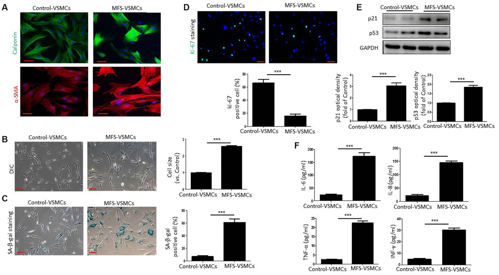 VSMCs isolated from the ascending aorta of MFS patients exhibit cellular senescence. (A) Representative images of immunofluorescent staining for α-SMA and calponin in control- and MFS-VSMCs. Scale bar=50 μm. (B) Representative light micrographs of control- and MFS-VSMCs. Cell size is expressed relative to control. Scale bar=100 μm. (C) Representative images and quantitative analysis of SA-β-gal staining in control- and MFS-VSMCs. Numbers of SA-β-gal-positive cells are expressed as percentages of the total numbers of control- or MFS-VSMCs. Scale bar=100 μm. (D) Representative images and quantitative analysis of immunofluorescent ki-67 staining in control- and MFS-VSMCs. Numbers of ki-67-positive cells are expressed as percentages of the total numbers of control- or MFS-VSMCs. Scale bar=100 μm. (E) Western blotting and quantitative analysis of p53 and p21 levels in control- and MFS-VSMCs. (F) Concentrations of IL-6, IL-8, TNF-α and INF-γ in medium conditioned by control- or MFS-VSMCs. Data are expressed as the mean±SEM. n=3. ***p