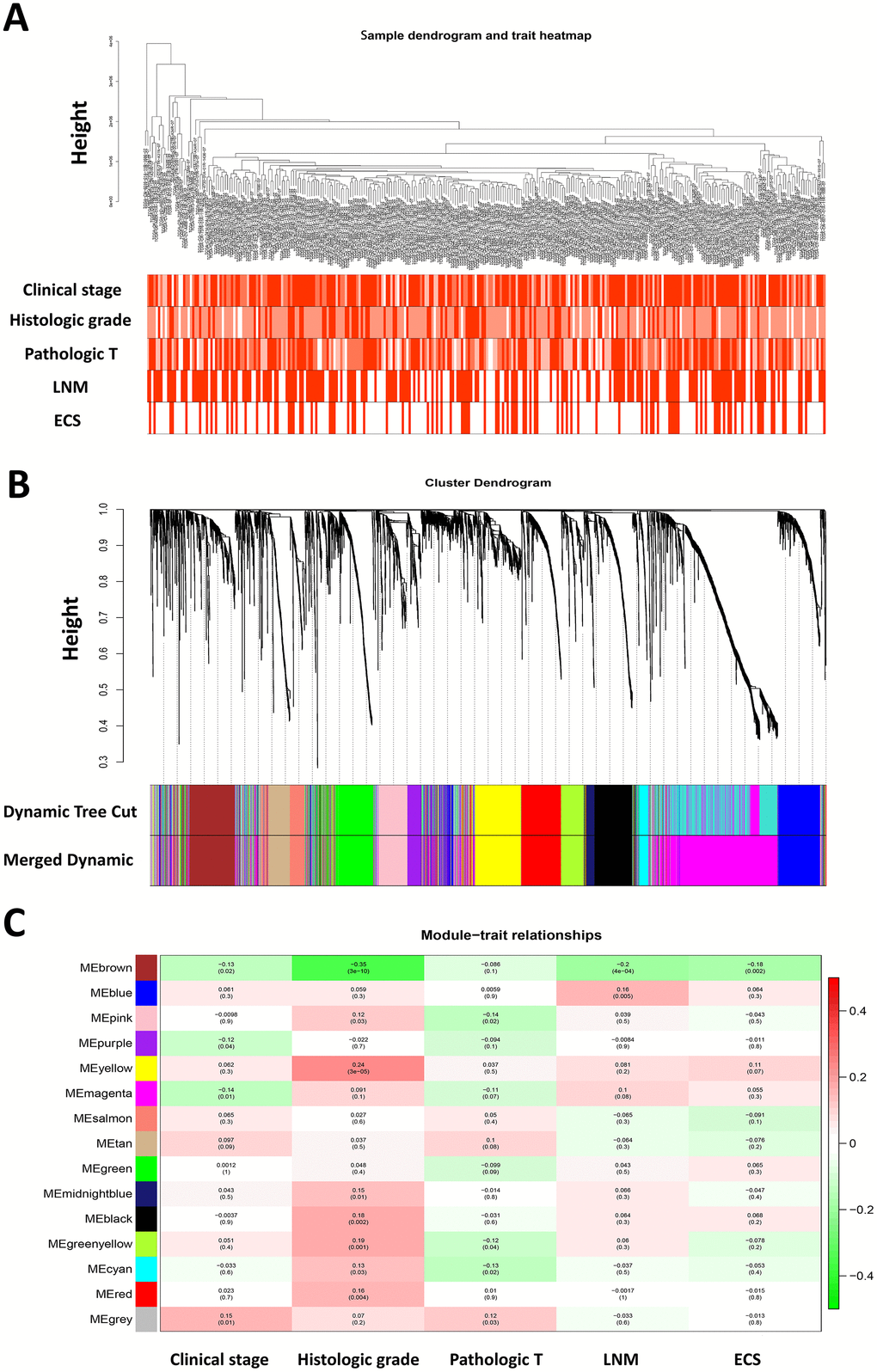 Weighted gene co-expression network analysis and identification of modules associated with the progression of HNSCC. (A) Clustering dendrogram of 299 HNSCC samples and the clinical traits. The clustering was based on the expression data of differentially expressed genes between tumor samples and normal samples in HNSCC. The color intensity was proportional to more advanced clinical stage as well as higher histologic grade and pathologic T stage. In lymph node metastasis (LNM) and nodal extracapsular spread (ECS), the red color represented pathologic nodal metastasis and nodal capsular spread. (B) Dendrogram of all differentially expressed genes clustered based on a dissimilarity measure (1-TOM). (C) Heatmap of the correlation between module eigengenes and disease progression features of HNSCC. The upper number in each cell refers to the correlation coefficient of each module in the trait, and the lower number is the corresponding p-value.