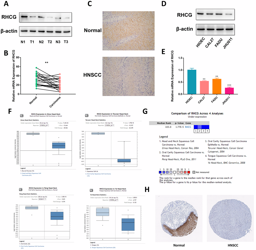 RHCG is downregulated in HNSCC tissues and cell lines. (A) Western blotting analysis of RHCG protein levels in HNSCC and normal tissues (n=3). (B) mRNA expression of RHCG in HNSCC and corresponding normal tissues (n=20). (C) Expression of RHCG as examined by immunohistochemistry (×400) in in HNSCC and normal tissues. (D) Western blotting analysis of RHCG expression in a human immortalized oral epithelial cell (HIOEC) line and HNSCC cell lines. (E) Real-time PCR analysis of relative RHCG mRNA expression levels HIOEC cells and HNSCC cell lines. (F) Comparison of RHCG expression in cancerous tissues and normal tissues in 4 different cohorts, including Ginos Head-Neck, Peng Head-Neck, Toruner Head-Neck and Ye Head-Neck according to the Oncomine database. (G) Meta-analysis of RHCG expression across the 4 analyses. (H) RHCG protein expressed in normal and HNSCC cancerous tissues from The Human Protein Atlas database. The tissue expressing abundant RHCG signals was normal tongue tissue from a female at an age of 73. RHCG was strongly stained in squamous epithelial cells, mainly located in cytoplasmic or membranous region; the tissue with no staining was head and neck squamous cell carcinoma tissue from an 81-year-old woman.