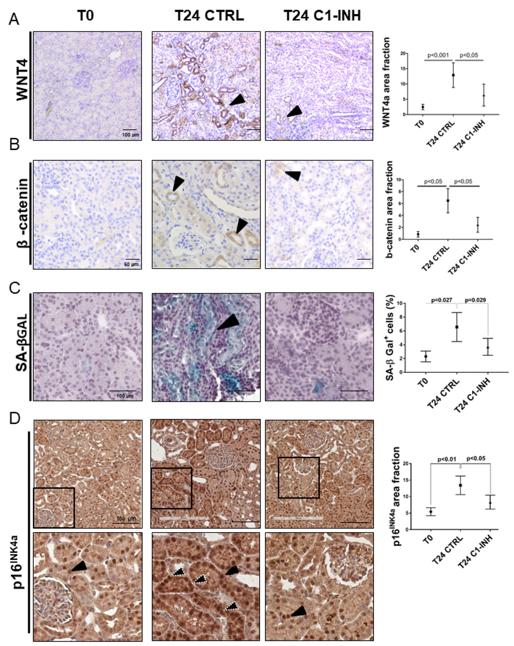 Wnt4/βcatenin pathway and inflammaging markers are activated in tubular cells after I/R and modulated by C1-INH treatment. (A–B) Immunoistochemical stainings showing the tubular Wnt4 and βcatenin increase after 1 day of I/R injury and the C1-INH-mediated modulation. IHC was performed on paraffin kidney sections. Arrows indicate positive tubular staining. (in the right) Graphical representation of Wnt4 and βcatenin protein expression level in the different groups. (n=5, p value as indicated, scale bar as indicated).(C) Representative SA-β Gal stained kidney tissues revealed an higher number of senescent cells after 24 h of I/R injury compared to T0. Treatment with C1-INH restored SA-β Gal at basal expression. Arrows indicate positive tubular staining on cryo tissues. (in the right) Graphical representation %SA-βGal area fraction. (n=5, p value as indicated, scale bar as indicated). (D) Representative micrographs indicating p16INK4a protein expression in different groups of swine, as indicated. Boxed areas are enlarged in the bottom of each micrographs. In the T0, p16INK4a had constitutive level and was localized in tubular nuclei (black arrow). Biopsies after 24h from reperfusion (T24 CTRL) showed increased nuclear (black arrow) and cytoplasmic staining (white dotted arrows). C1-INH restored p16INK4a at basal expression; limiting the cytoplasmic p16INK4a expression. (in the right) Graphical representation of p16INK4a area fraction in the different groups. (n=5, p value as indicated, scale bar as indicated).