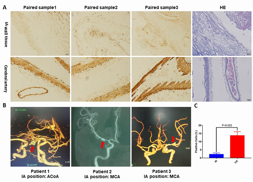 (A) Representative pictures of NOTCH3 immunohistochemistry staining or hematoxylin and eosin staining of IA and cerebral artery tissues. (B) Reconstructed images from diagnostic CTA and DSA scans. The red arrows indicate the location of the IA. (C) Percentage of positively stained cells in panel (A) as measured using Image J. ACoA: anterior communicating artery, MCA: middle cerebral artery. p