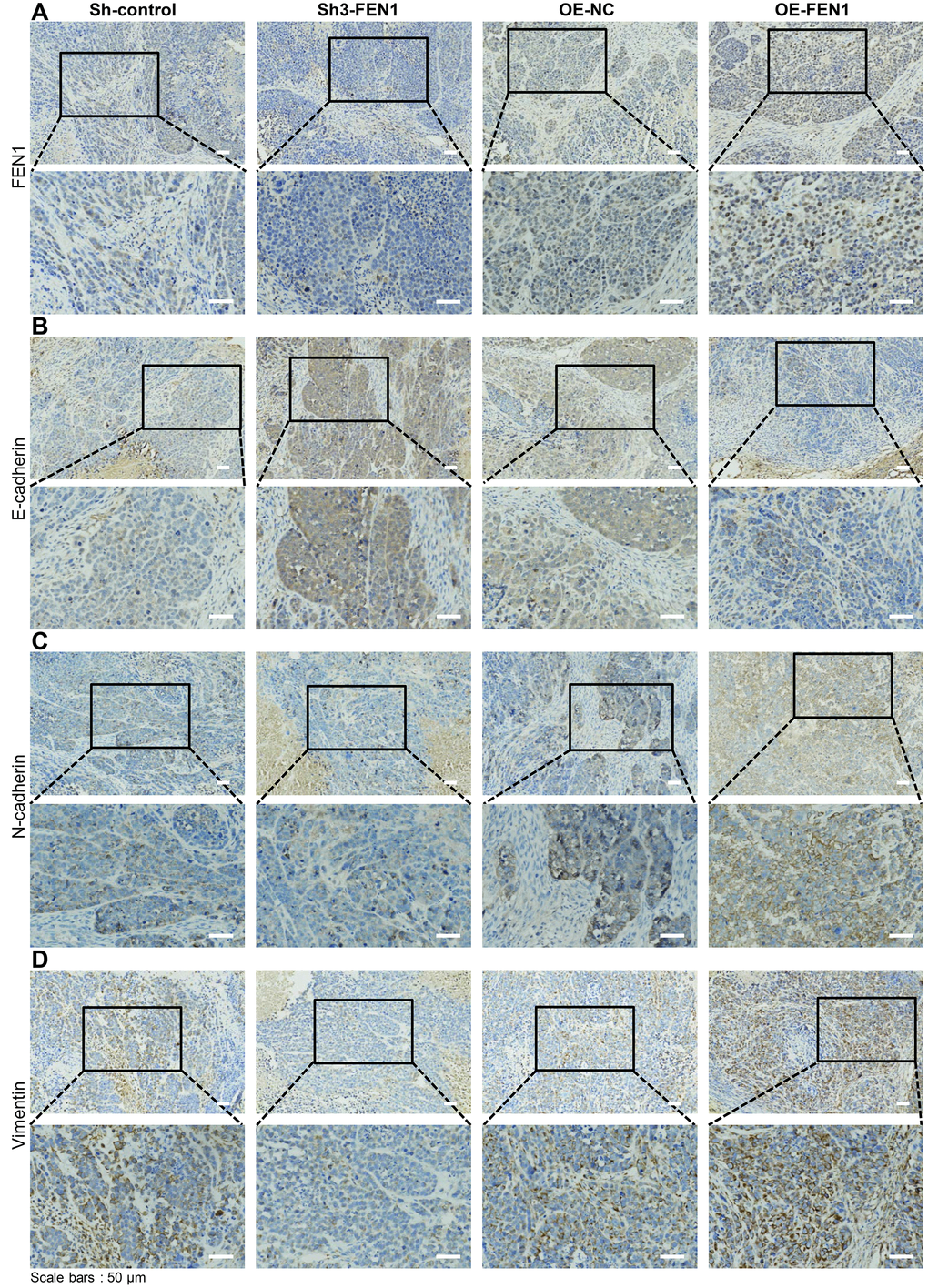 FEN1 induces EMT in vivo. (A) IHC staining of FEN1 in xenograft tumor tissue. (B) IHC staining of E-cadherin in xenograft tumor tissue. (C) IHC staining of N-cadherin in xenograft tumor tissue. (D) IHC staining of vimentin in xenograft tumor tissue; original magnification, 200 x for the upper panels and 400 x for the lower panels in each figure.