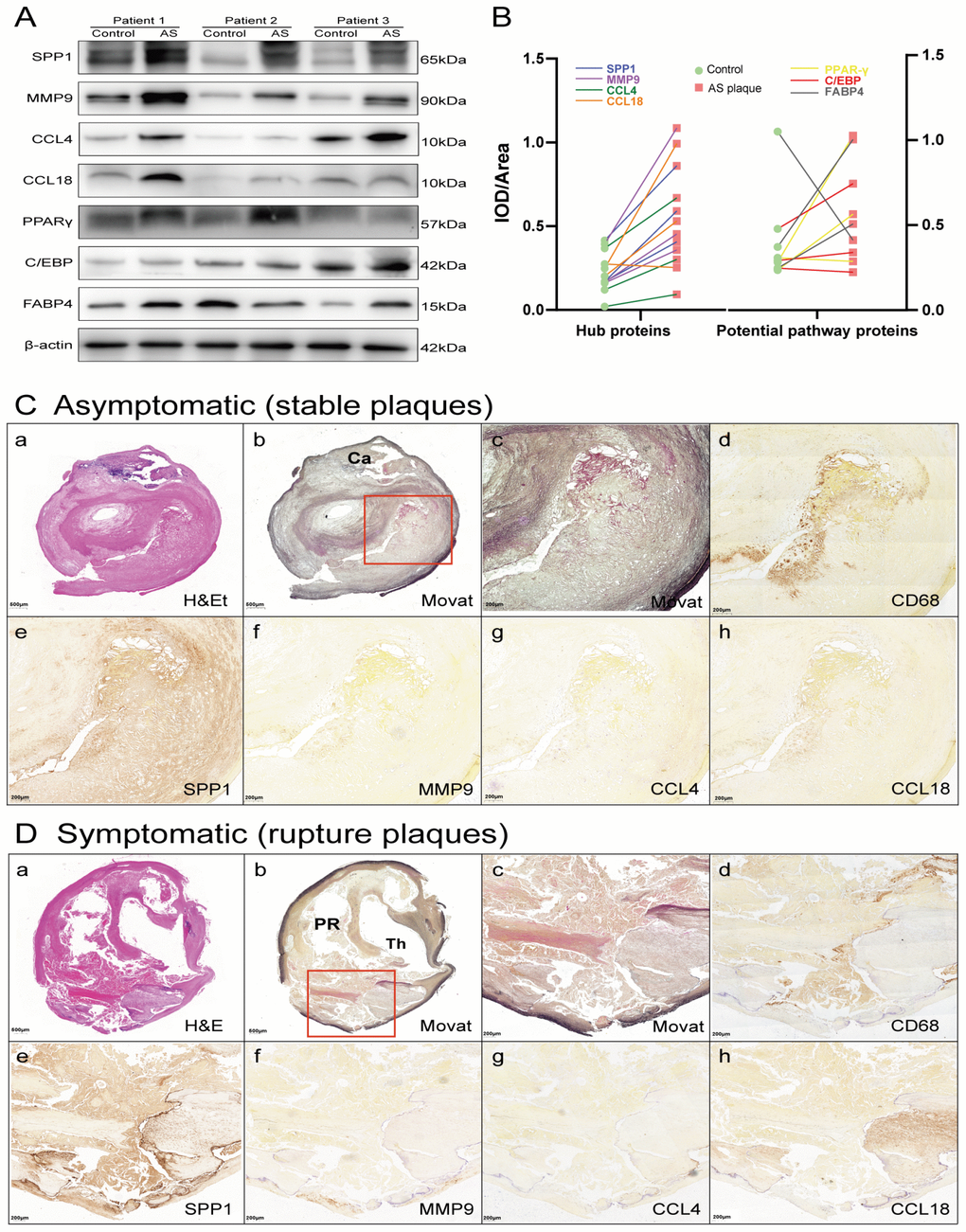 Hub proteins and potential pathway proteins were increased in AS plaques, especially in tissue sections of ruptured plaques. (A) Detection of hub proteins (SPP1, MMP9, CCL4, and CCL18) and potential pathway proteins (PPARγ, C/EBP and FABP4) in ruptured plaques and adjacent normal tissues by western blots. β-actin was used as a loading control. Bands were quantified with ImageJ software. (B) Line chart showing IOD/area of proteins in immunoblot analysis. Red squares represent AS plaques, and the green circles indicate adjacent normal tissues. The different colored lines represent the trend of protein expression. (C, D) H&E (a) and Movat (b and c, low and high power) staining and immunoperoxidase antibody staining using anti-CD68 (d), anti-SPP1 (e), anti-MMP9 (f), anti-CCL4 (g), and anti-CCL18 (h). Ca, calcification; PR, plaque rupture; Th, thrombus.