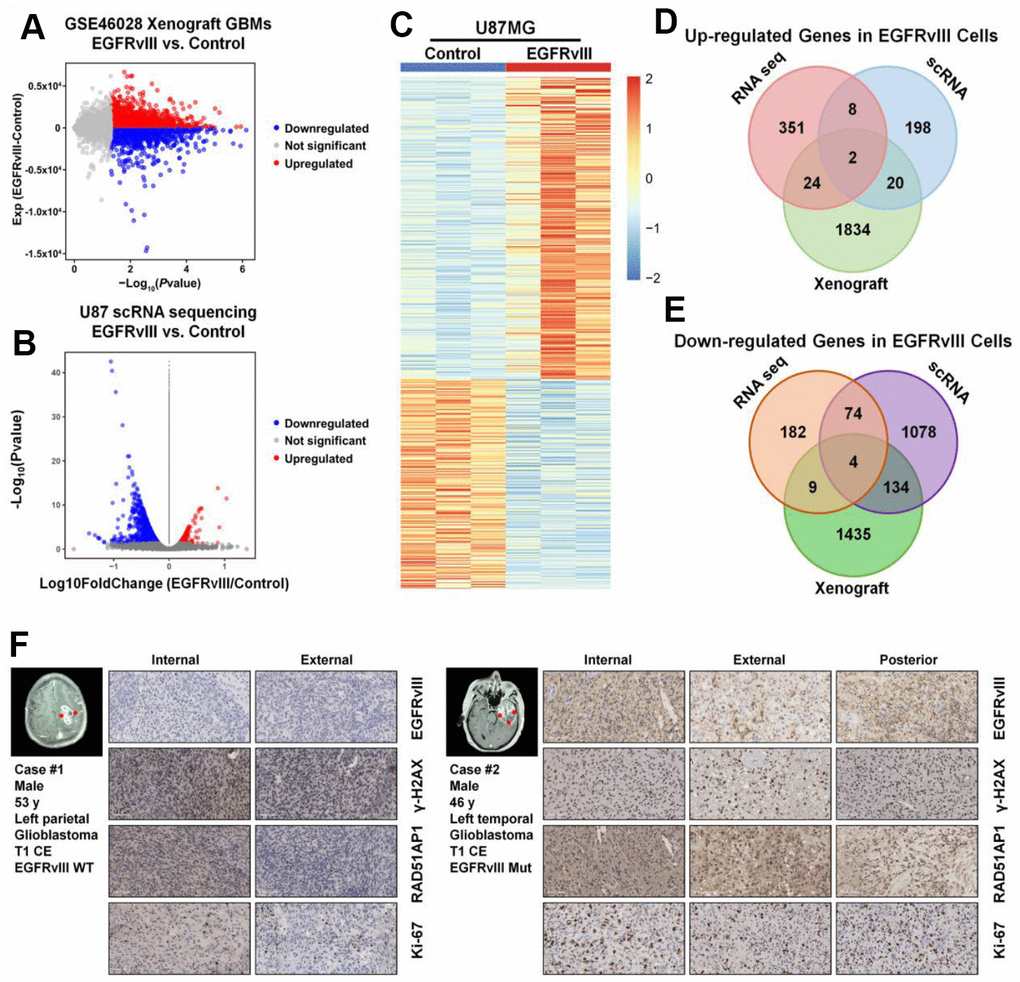 RAD51AP1 is upregulated in EGFRvIII-positive cells. The volcano plot was constructed to profile the differentially expressed genes observed in GES46028 (A) and scRNA-seq data (B). (C) A heatmap was employed to profile the differentially expressed genes observed in U87MG/U87MG-EGFRvIII RNA-seq data. A Venn diagram was used to profile the common upregulated (D) and downregulated (E) genes in three databases. (F) The EGFRvIII, r-H2A.x, RAD51AP1 and Ki-67 expression levels in multipoint samples from two patients were examined by IHC staining.